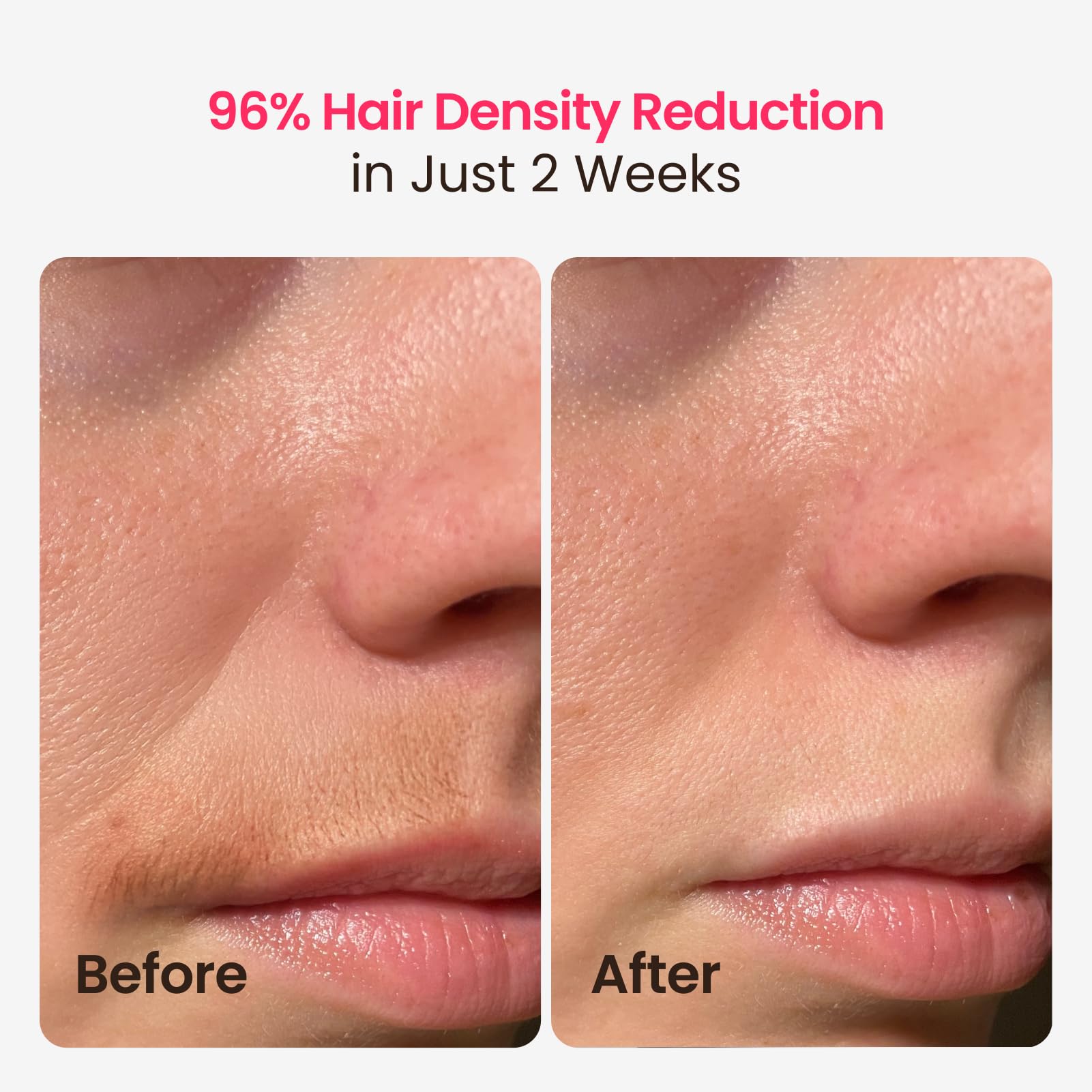 TRIPLE-Pulse IPL Laser Hair Removal, 12cm² Sapphire 37°F Ice-Cooling Contact, Hair Removal Device for Women and Men, Permanent Hair Removal at Home for Legs, Face, Bikini, Armpits, Trinity iGlow 10 - Medaid International