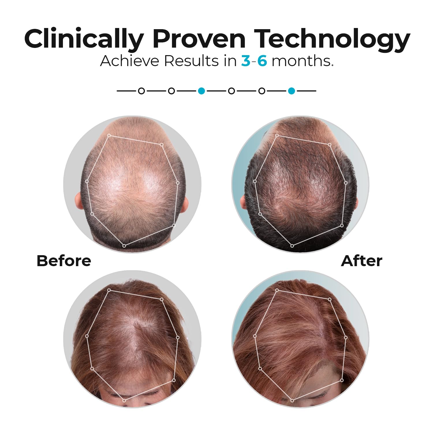 Capillus Pro Mobile Laser Therapy Cap for Hair Regrowth, with 272 Red Light Lasers for Laser Hair Growth, Red Light Hair Growth - Medaid International