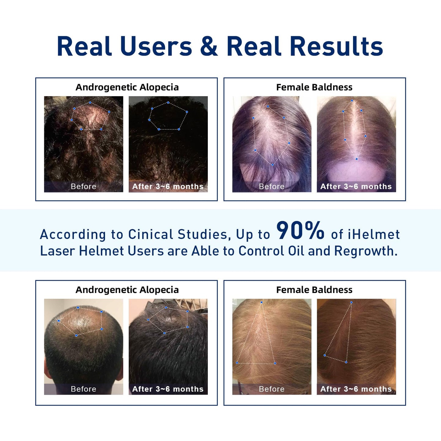 iHelmet Laser Hair Growth System (FDA Cleared), Hair Regrowth Helmet & Laser Cap, Hair Loss Treatment for Men and Women, Low Level Laser Therapy for Hair Growth, Anti-Thining Treatment，160 Blue - Medaid International