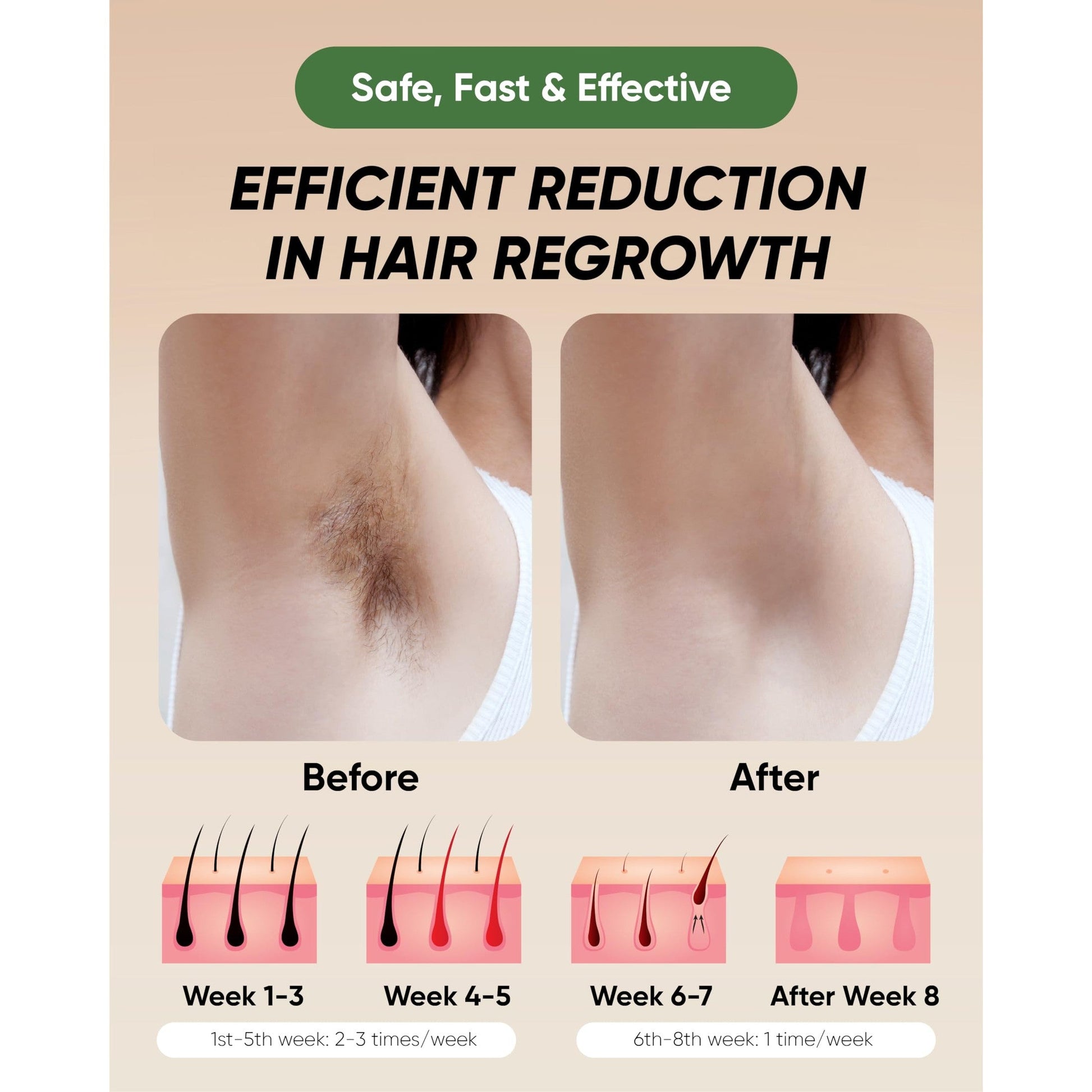 XSOUL At-Home IPL Hair Removal for Women and Men Permanent Hair Removal 999,999 Flashes Painless Hair Remover on Armpits Back Legs Arms Face Bikini Line, Corded - Medaid International