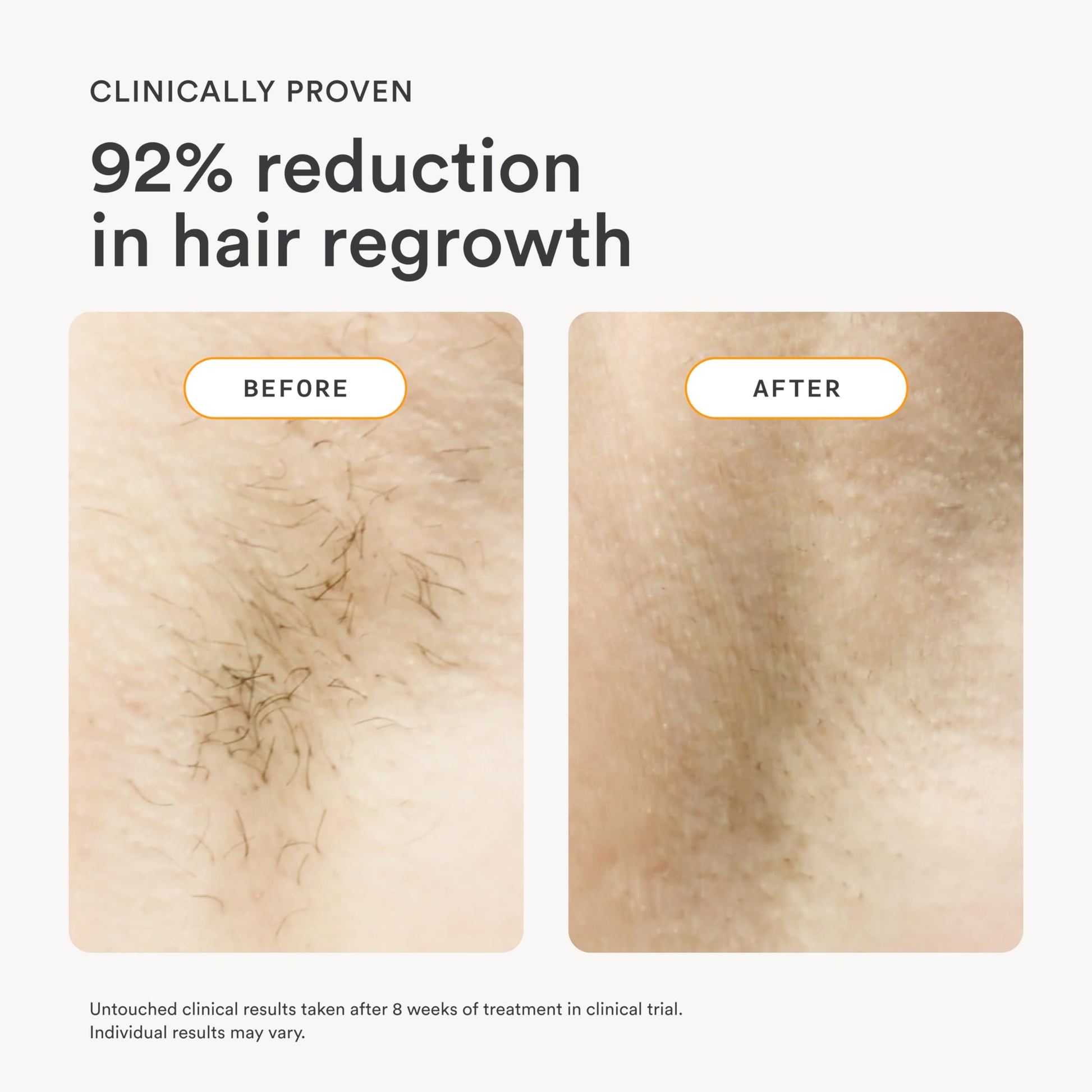 NEW Flasher 2.0 by Nood, IPL Laser Hair Removal Device for Men and Women, Pain-free and Permanent Results, Safe for Whole Body Treatment - Matte Black - Medaid International