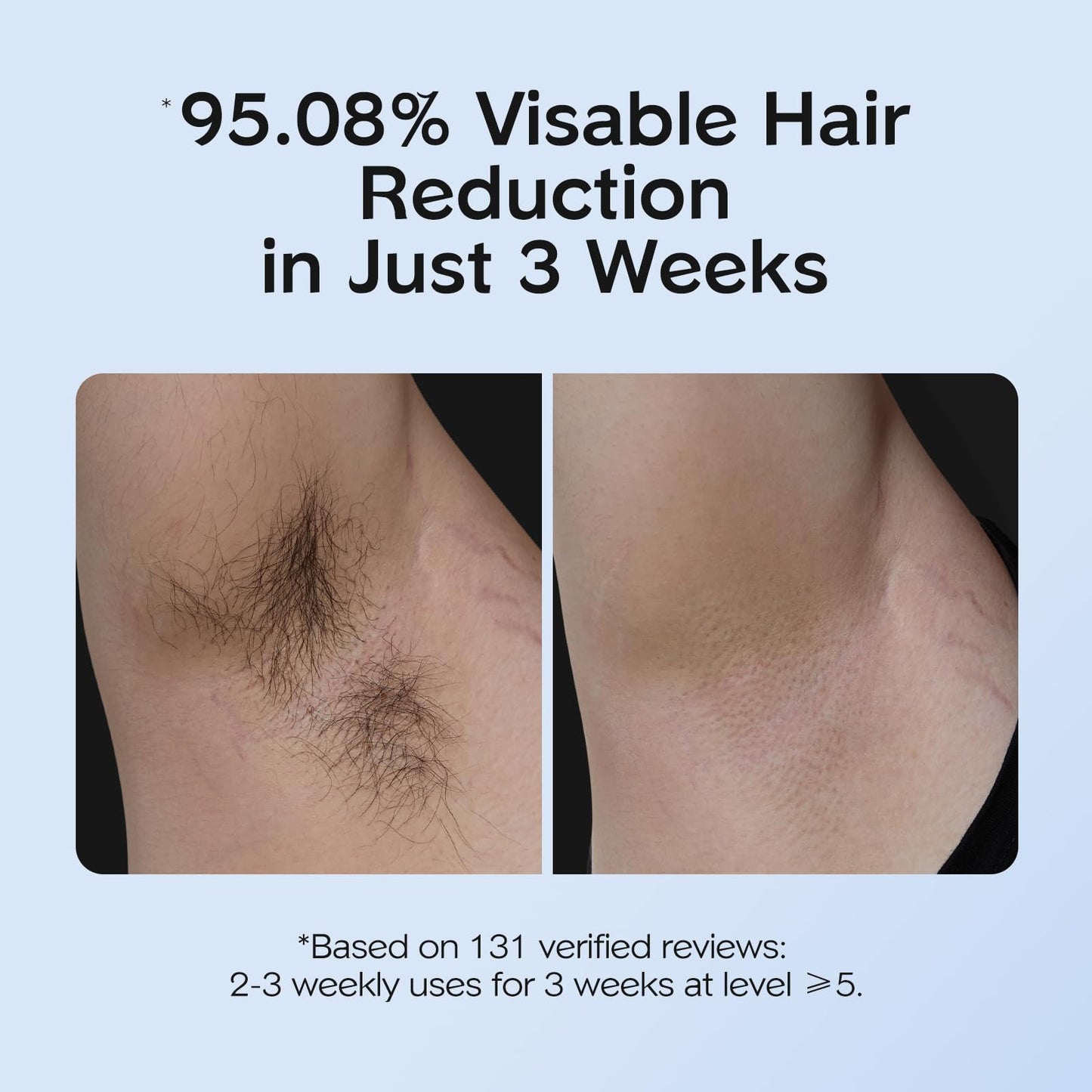 INNZA IPL Hair Removal with Ice Cooling Care Function for Women,Long-Lasting Results,999,999 Flashes Painless Hair Removal, Hair Removal Device for Armpits Legs Arms Bikini Line - Medaid International