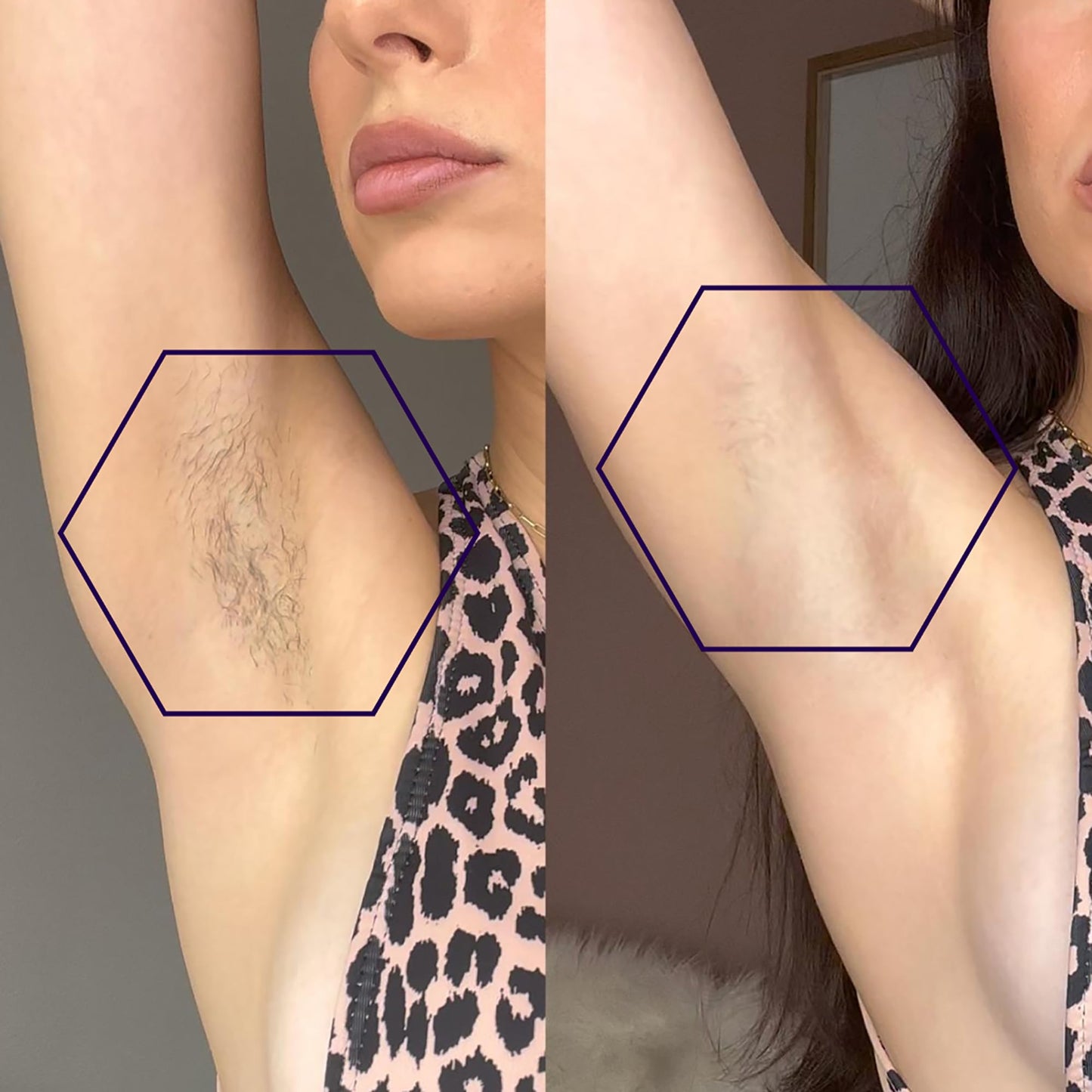MICHAEL TODD BEAUTY - LUMOS Laser IPL Hair Removal for Women and Men, 50°F CoolMax Technology, 999,999 flashes, 3 In 1 w/Skin Sensor for Nearly Painless, Permanent hair removal - Medaid International