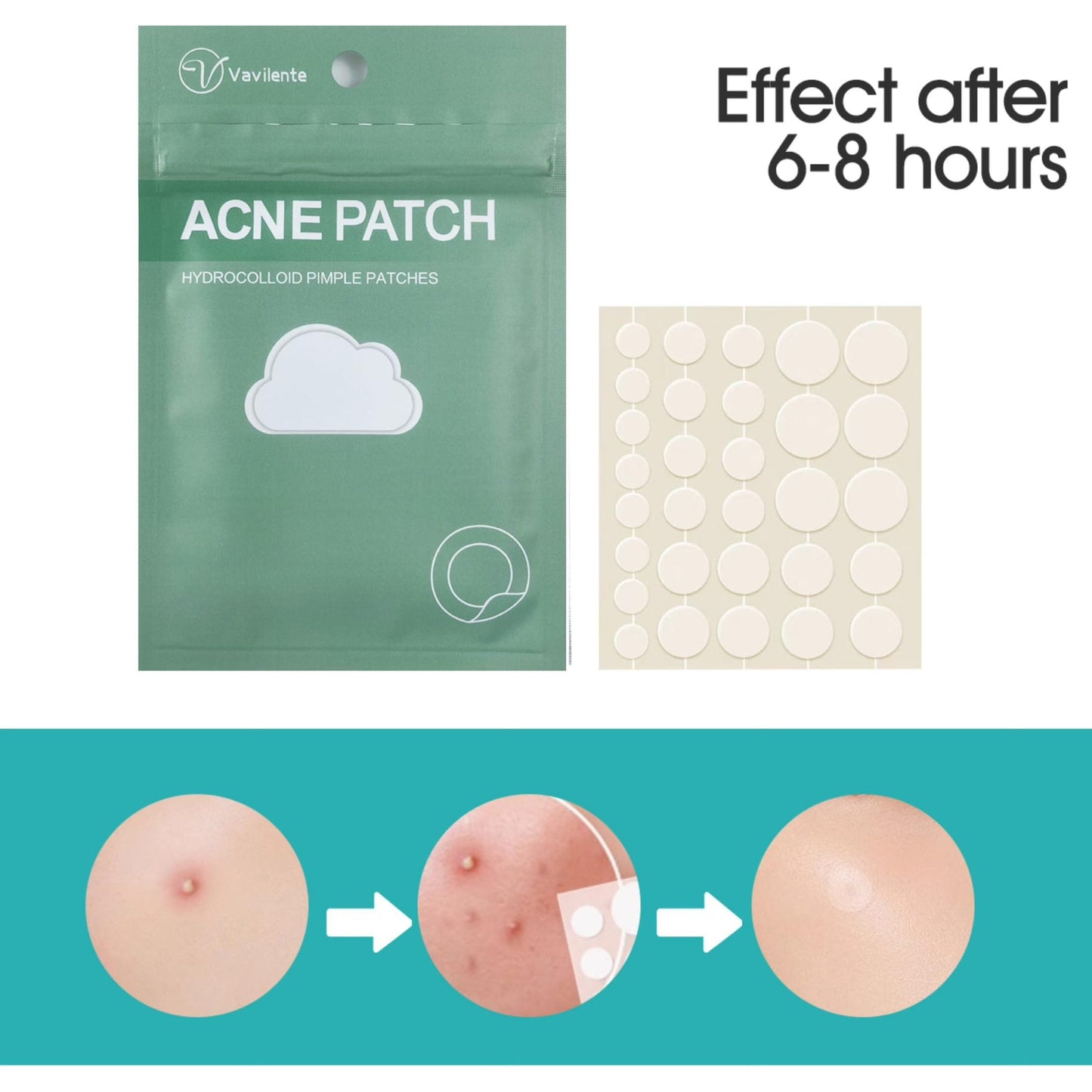 Vavilente Acne Pimple Patches, Hydrocolloid Acne Patches with Tea Tree Oil,Salicylic Acid & Calendula Oil,Pimple Patch for Face, Zit Patches,Pimple Stickers(150 Count) - Medaid International
