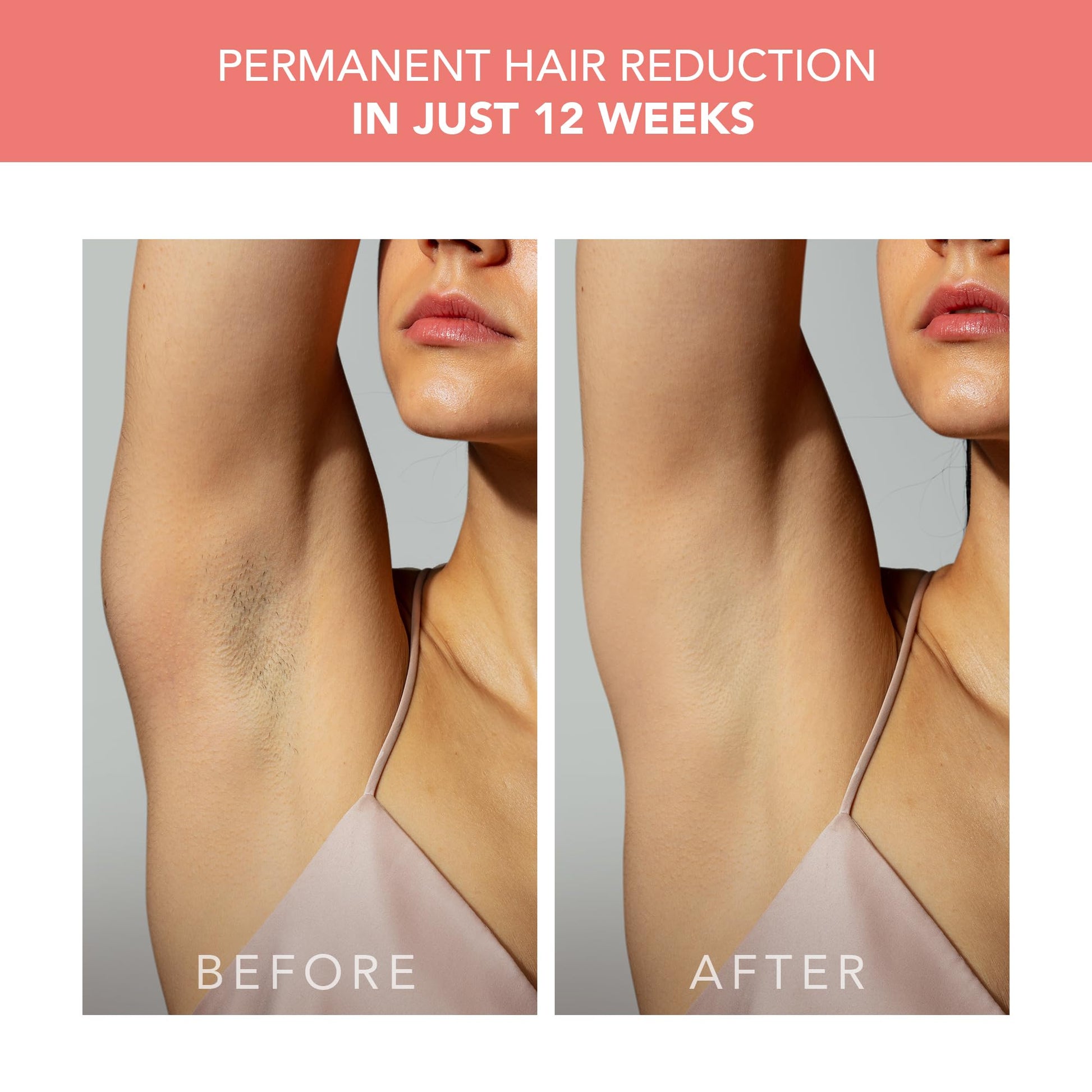 FOREO PEACH 2 IPL Hair Removal Device – Quick & Gentle Hair Reduction – For Full Body & Face – Skin Cooling System – Silicone Shield - Coral - Medaid International