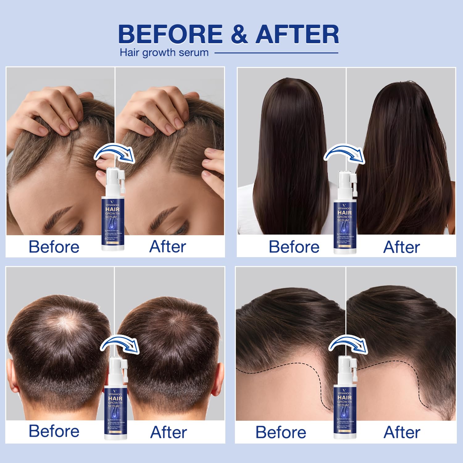 VENANOCI Hair Growth Serum Spray: with Rosemary, Biotin, Batana Oil & Rice Water – Natural Anti-Hair Loss Treatment for Thinning Hair – Promotes Thicker, Fuller Hair for Women & Men – All Hair Types - Medaid International