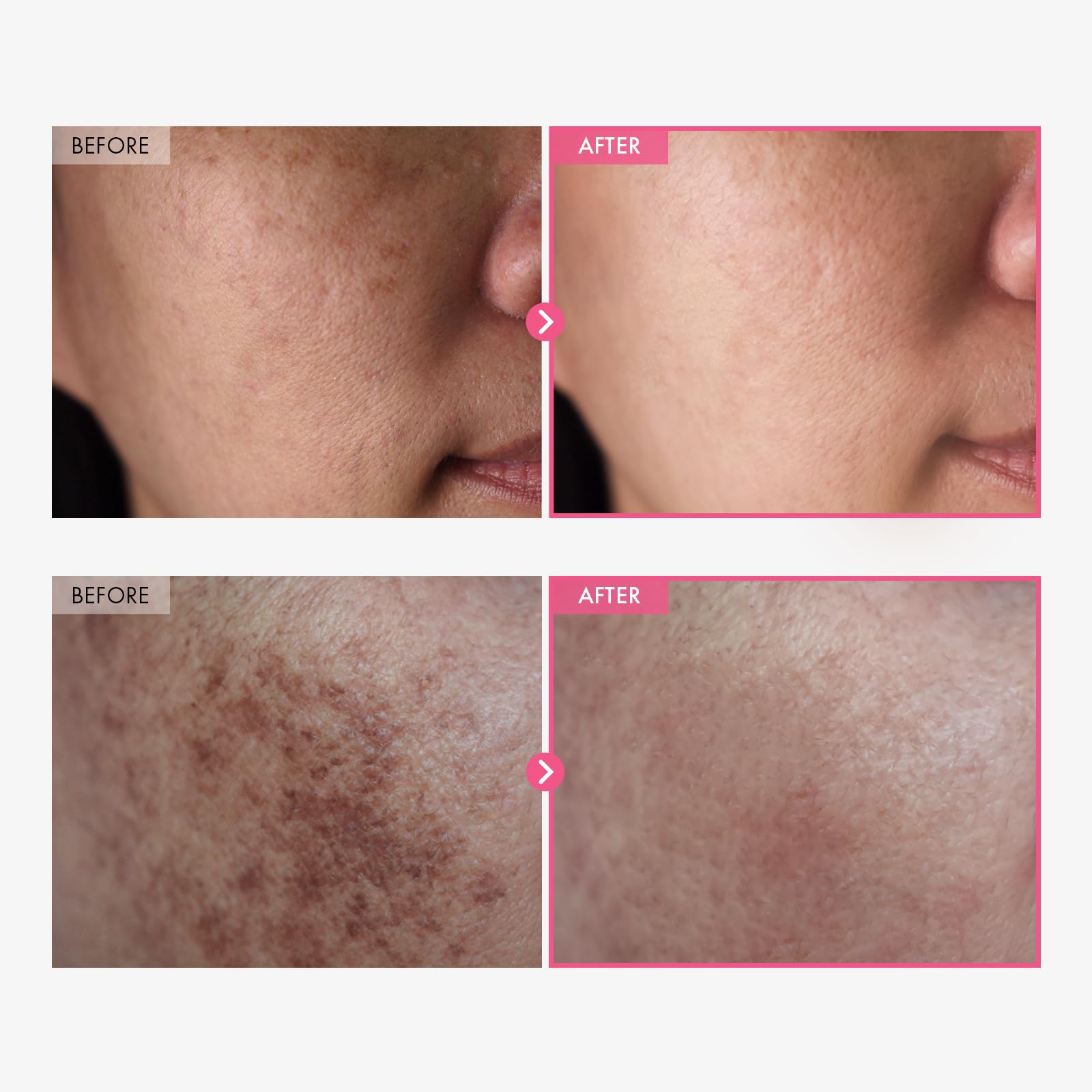 TOSOWOONG Arbutin 7% + Tranexamic Acid 4% Cream, 70,000ppm Arbutin, 40,000ppm TXA, Niacinamide, Glutathione, Dark Spots, Freckle, Blemishes, Pigmentation, Korean Skin Care, 50ml, 1.69 fl.oz. - Medaid International