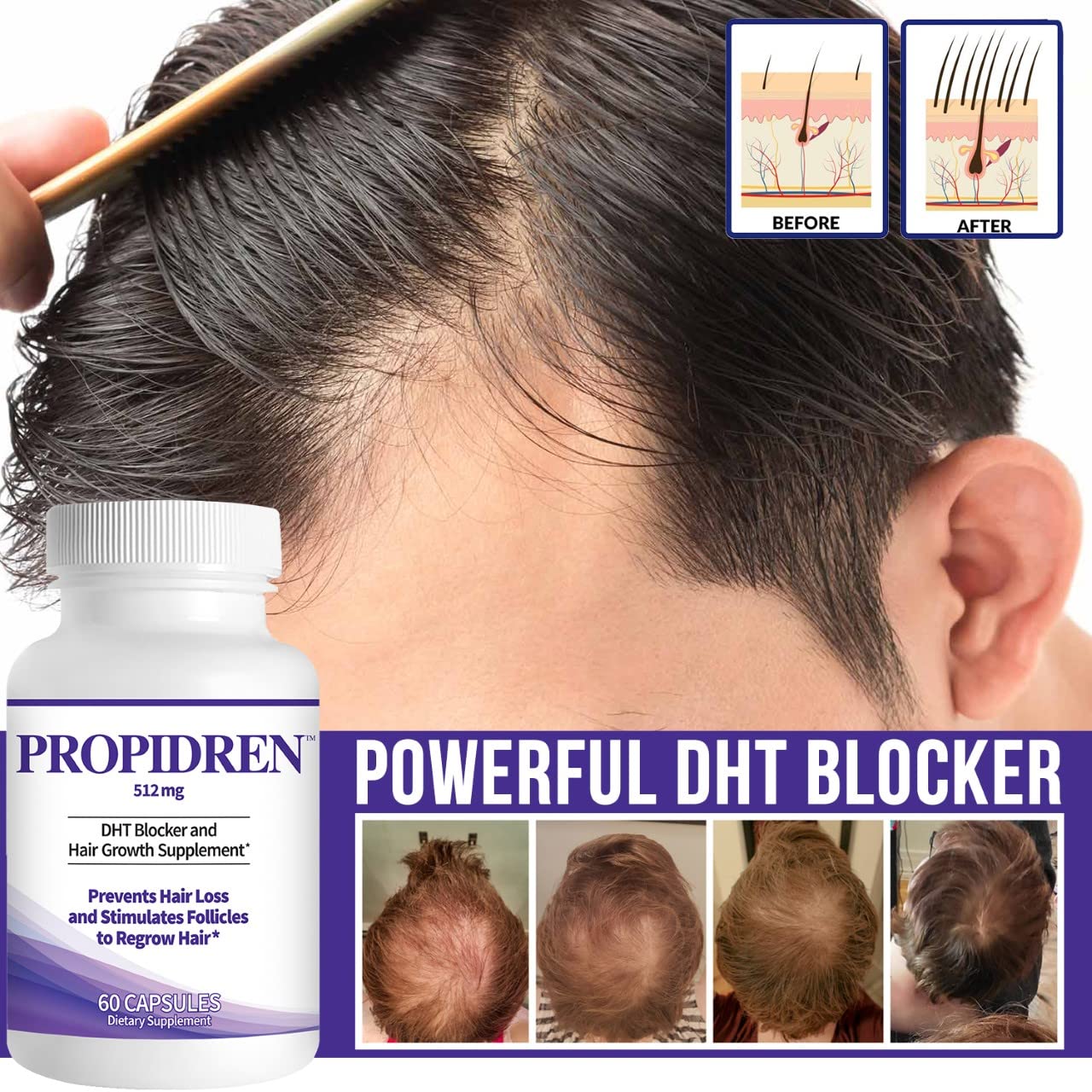 Propidren by HairGenics - DHT Blocker & Hair Growth Capsules to Prevent Hair Loss & Stimulate Hair Follicles, to Stop Hair Loss & Regrow Hair. Proprietary Anti-Hair Loss & Hair Regrowth Treatment. - Medaid International