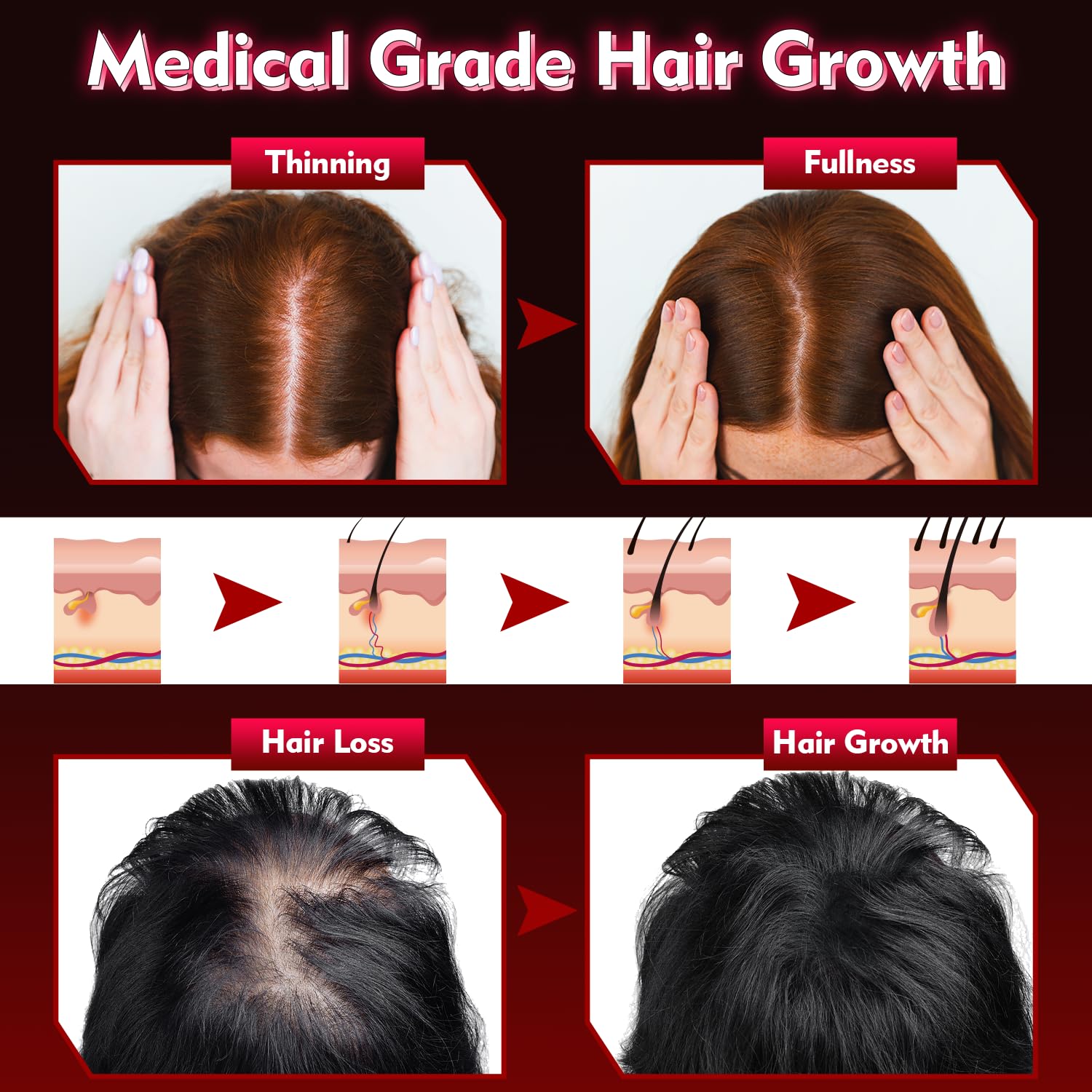Hair Growth Device - FDA Cleared - UUPAS Professional Laser Diodes Red Light Therapy Hair Growth Cap System for Hair Regrowth, Alopecia - Hair Growth Treatments Products for Men Women - Medaid International