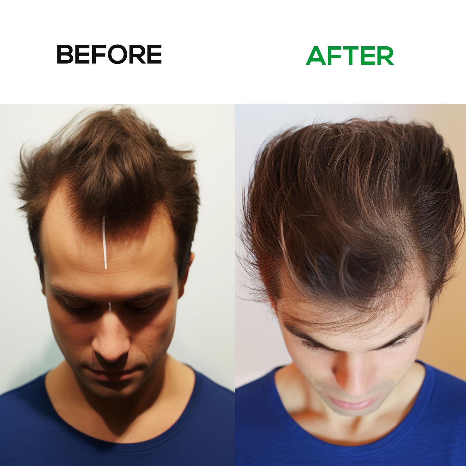 Laser Hair Growth Cap, Low level laser therapy (LLLT) equipment for promoting hair growth in women and men - Medaid International