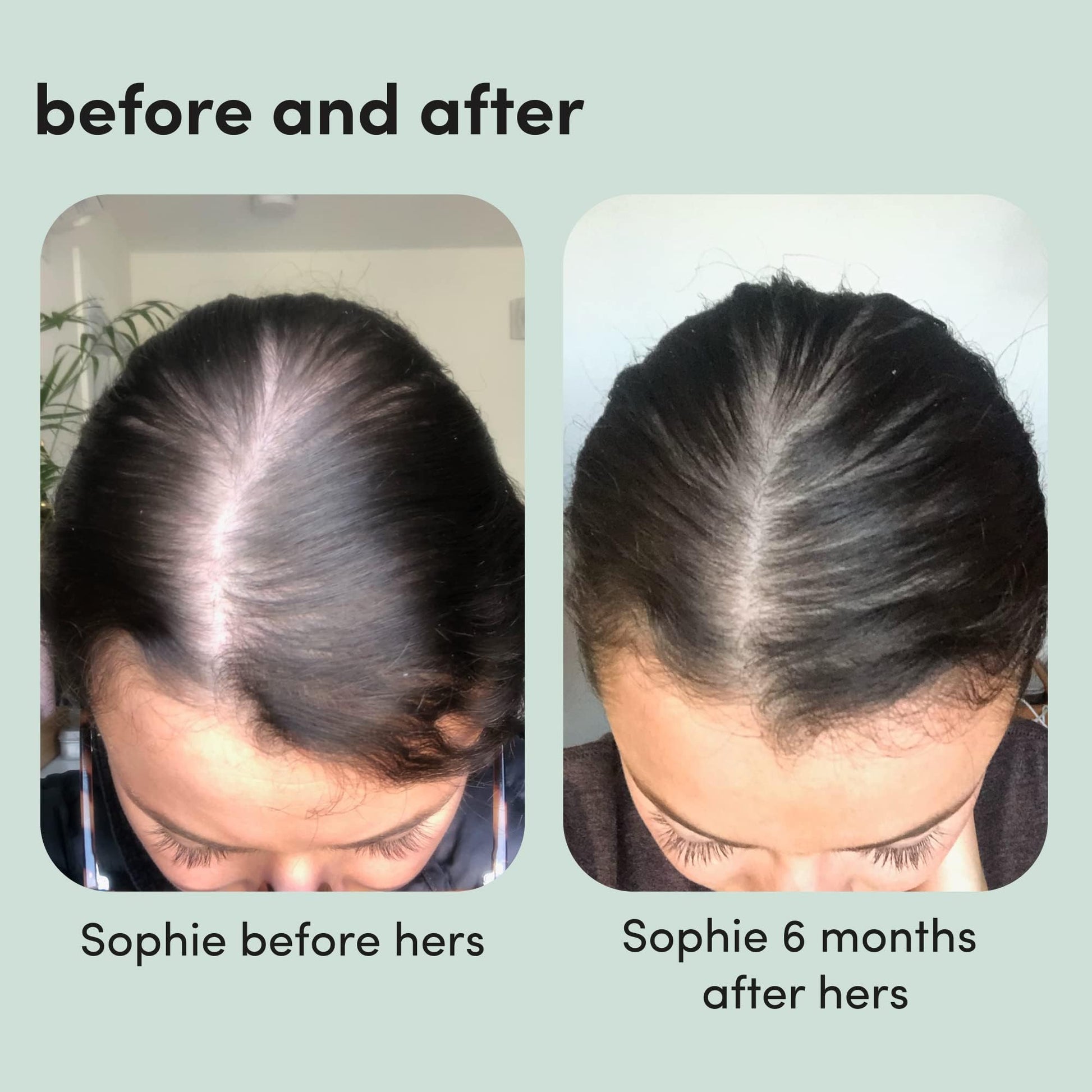 hers Hair Regrowth Treatment - Topical Minoxidil 5% Foam for Women - Extra Strength - Supports Thicker, Fuller Hair - Non-Greasy - Unscented, 2 Pack - Medaid International