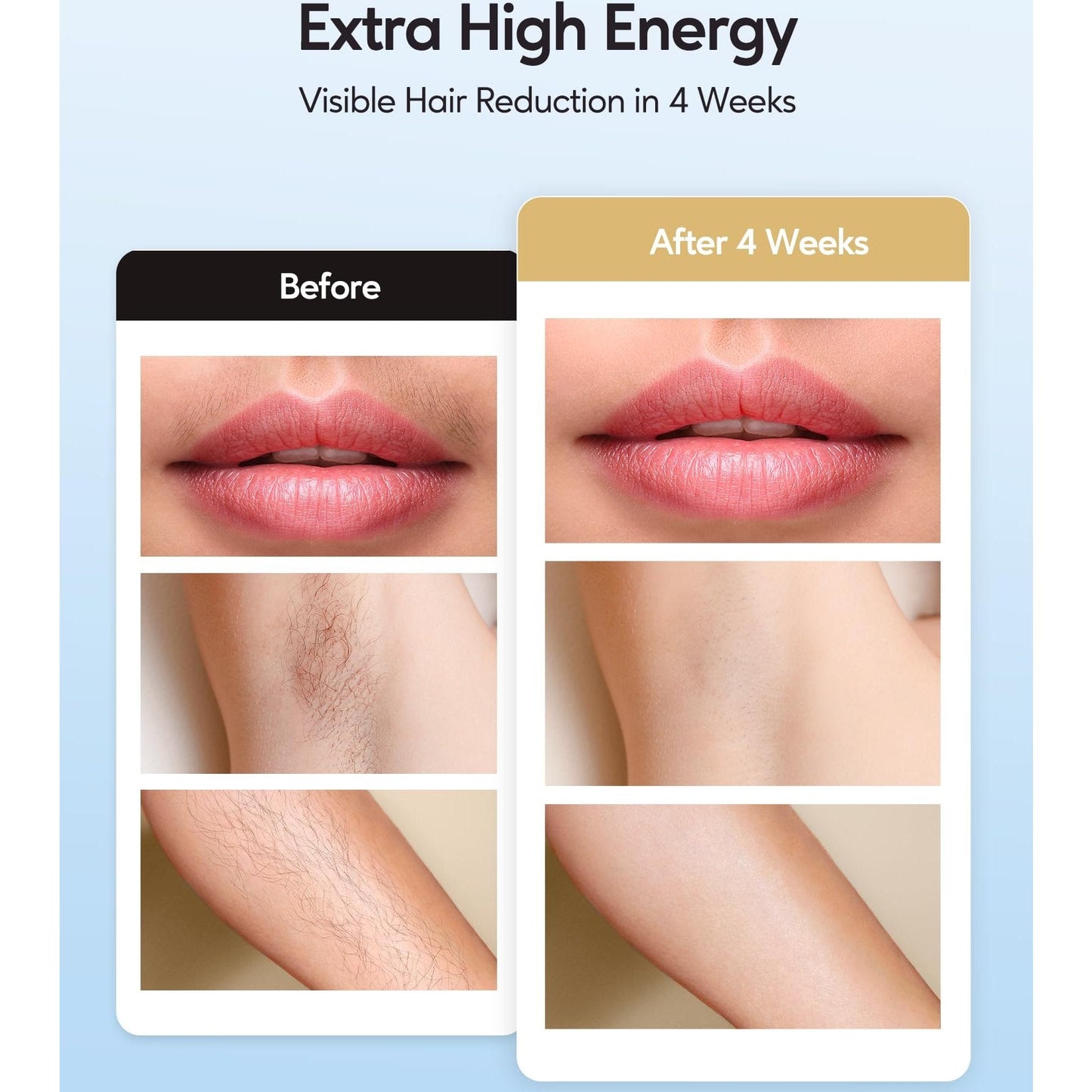INNZA IPL Hair Removal with Ice Cooling Care Function for Women,Long-Lasting Results,999,999 Flashes Painless IPL Hair Remover, Hair Removal Device for Armpits Legs Arms Bikini Line - Medaid International