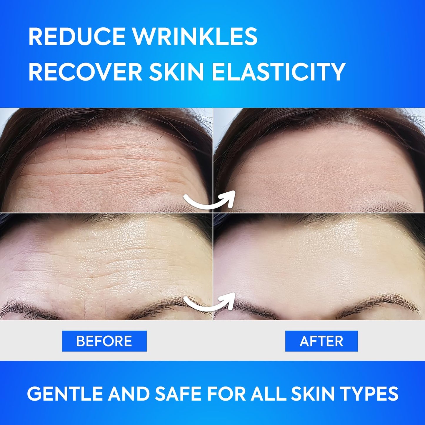 SILKDERMIS Forehead Wrinkle Patches 12Pcs with Aloe, Collagen, Vitamin E, Anti Wrinkle Patches, Forehead Wrinkles Treatment - Medaid International
