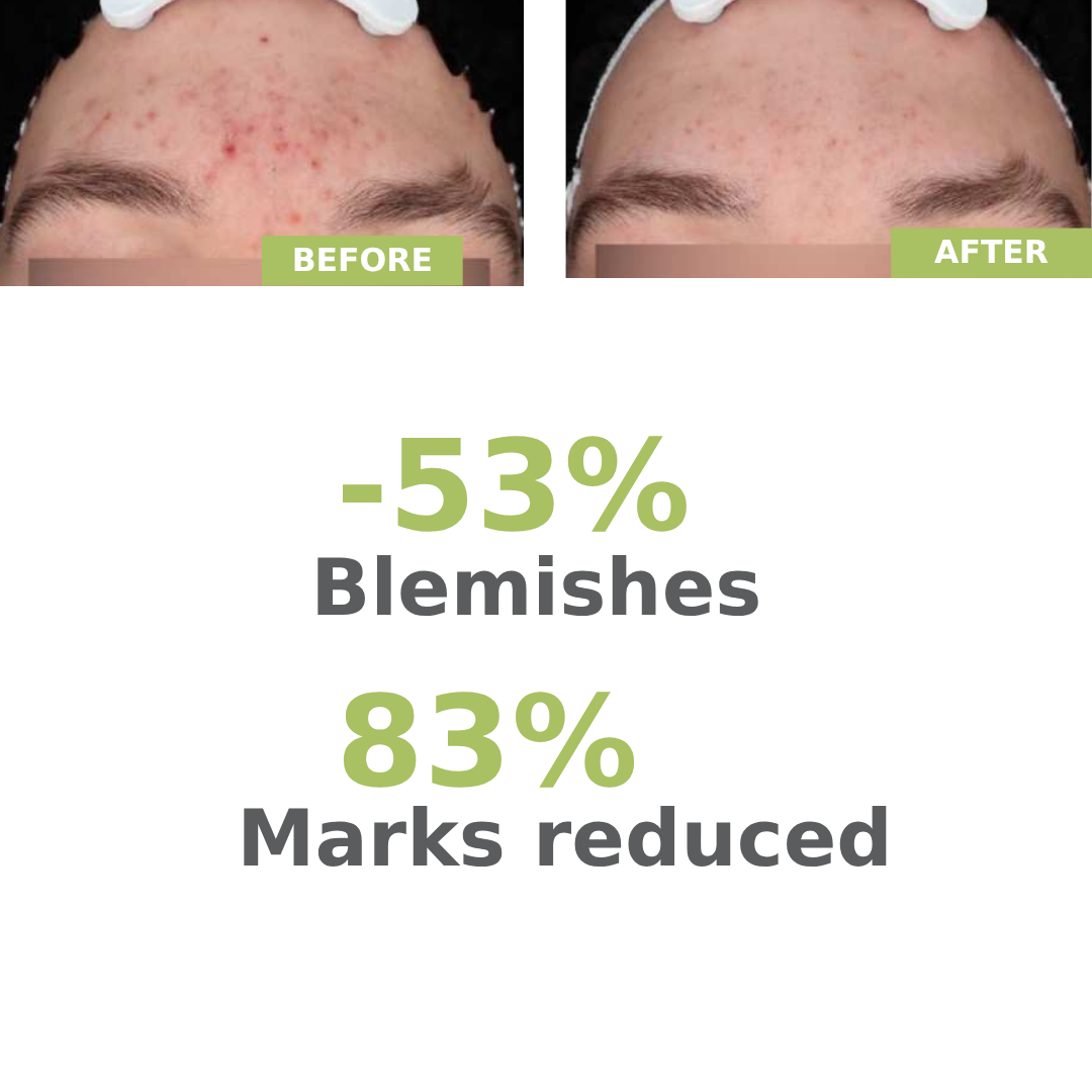 Biology AC Night Peel Anti-Blemish Serum