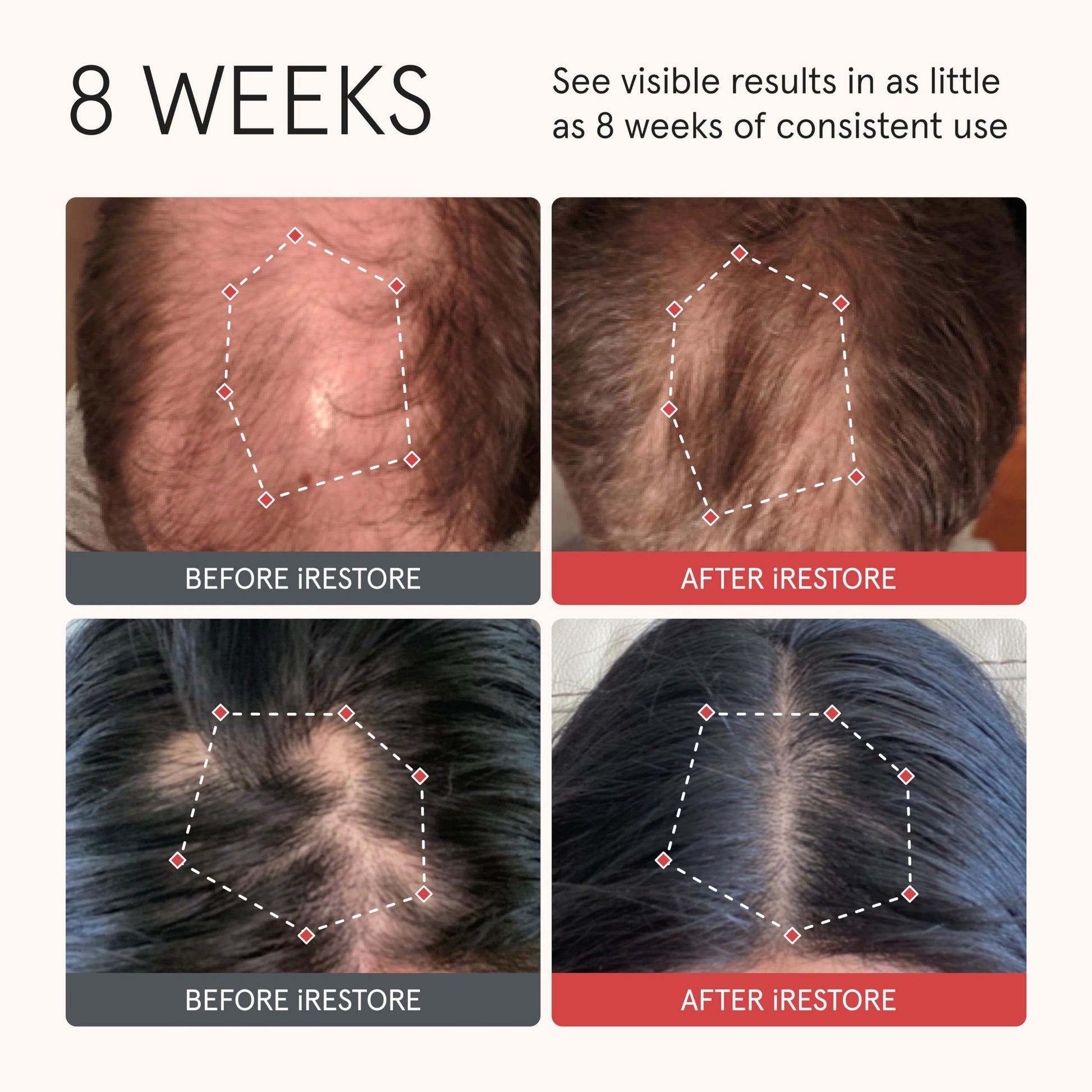 iRESTORE Biotin Hair Conditioner for Damaged Dry Hair - Good for Fine Hair Growth, Volumizing Thickening Conditioner with Ginseng & Argan Oil to Moisturize, Pair With Hair Loss Shampoo - Medaid International
