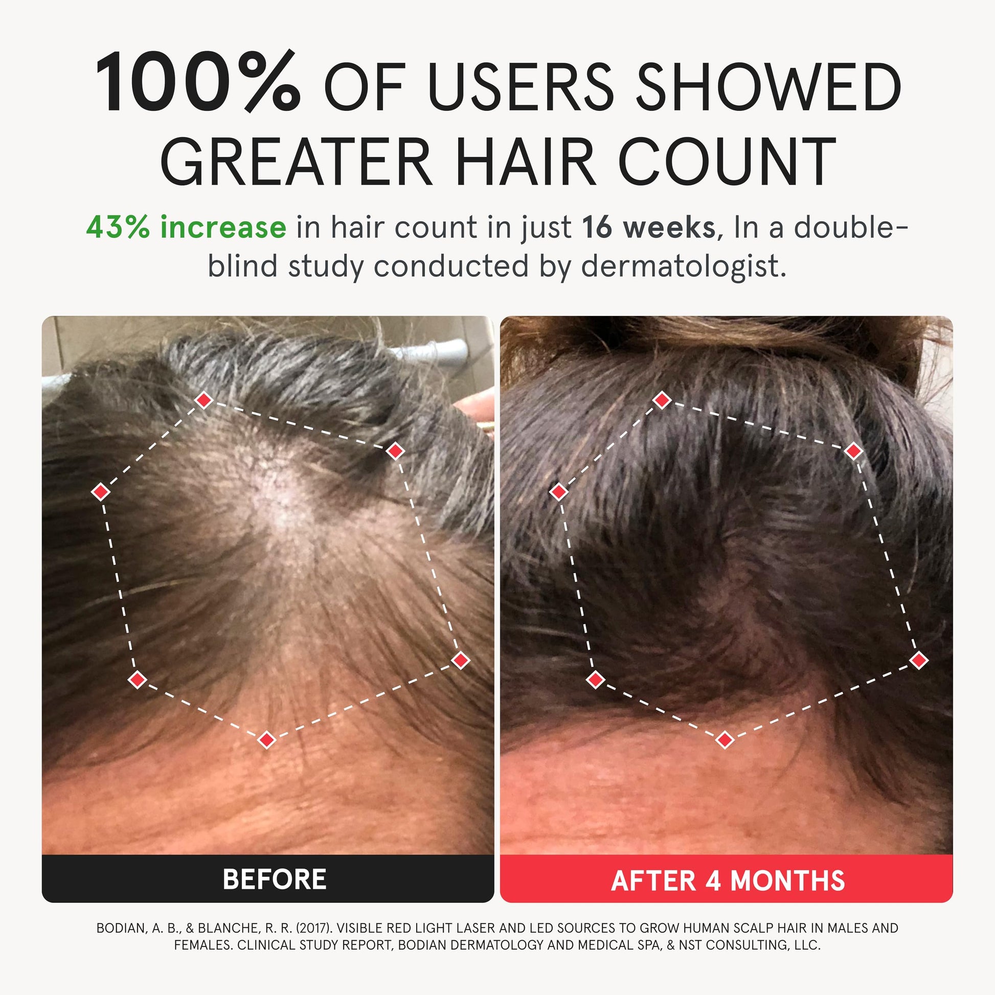 iRestore Elite - Laser Red Light Therapy for Hair Growth System - FDA Cleared Hair Loss, Hair Thinning & Alopecia Treatment for Men & Women - Laser Cap for Hair Regrowth Stimulates Denser Fuller Hair - Medaid International