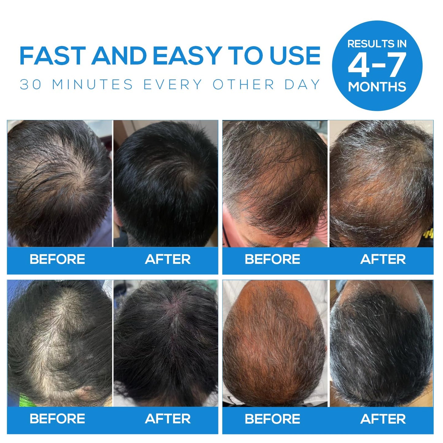 Tkcsoi Laser Hair Growth Cap，Laser Hair Growth Cap is Low Level Laser Therapy (LLLT) Devices That Promote Hair Growth in Women and Men - Medaid International