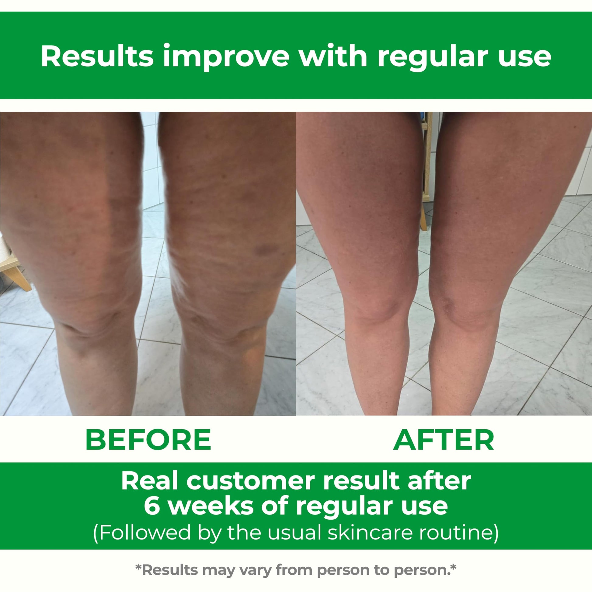 TESMED Anti Cellulite Massager: Clinically Proven Efficacy, Made in Italy, with Converging & Diverging Roller Technology. Patented Cellulite Roller for Thighs and Buttocks. - Medaid International