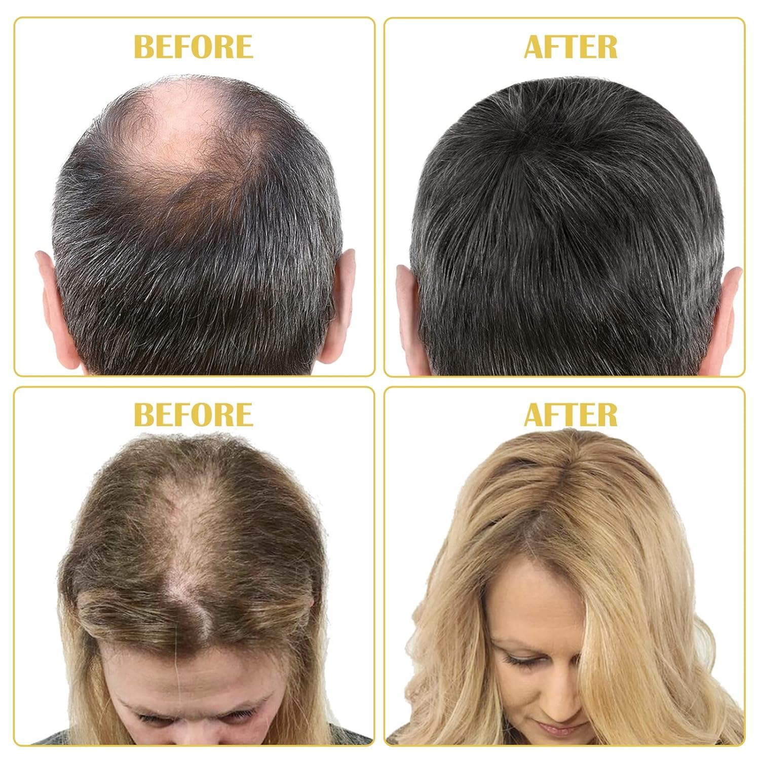 5% Minoxidil for Men and Women Hair Growth Oil, Minoxidil Hair Growth Serum Infused with Biotin for Hair Regrowth Treatment, Scalp Hair Loss Hair Thinning, Natural Hair Growth 2.02 oz - Medaid International