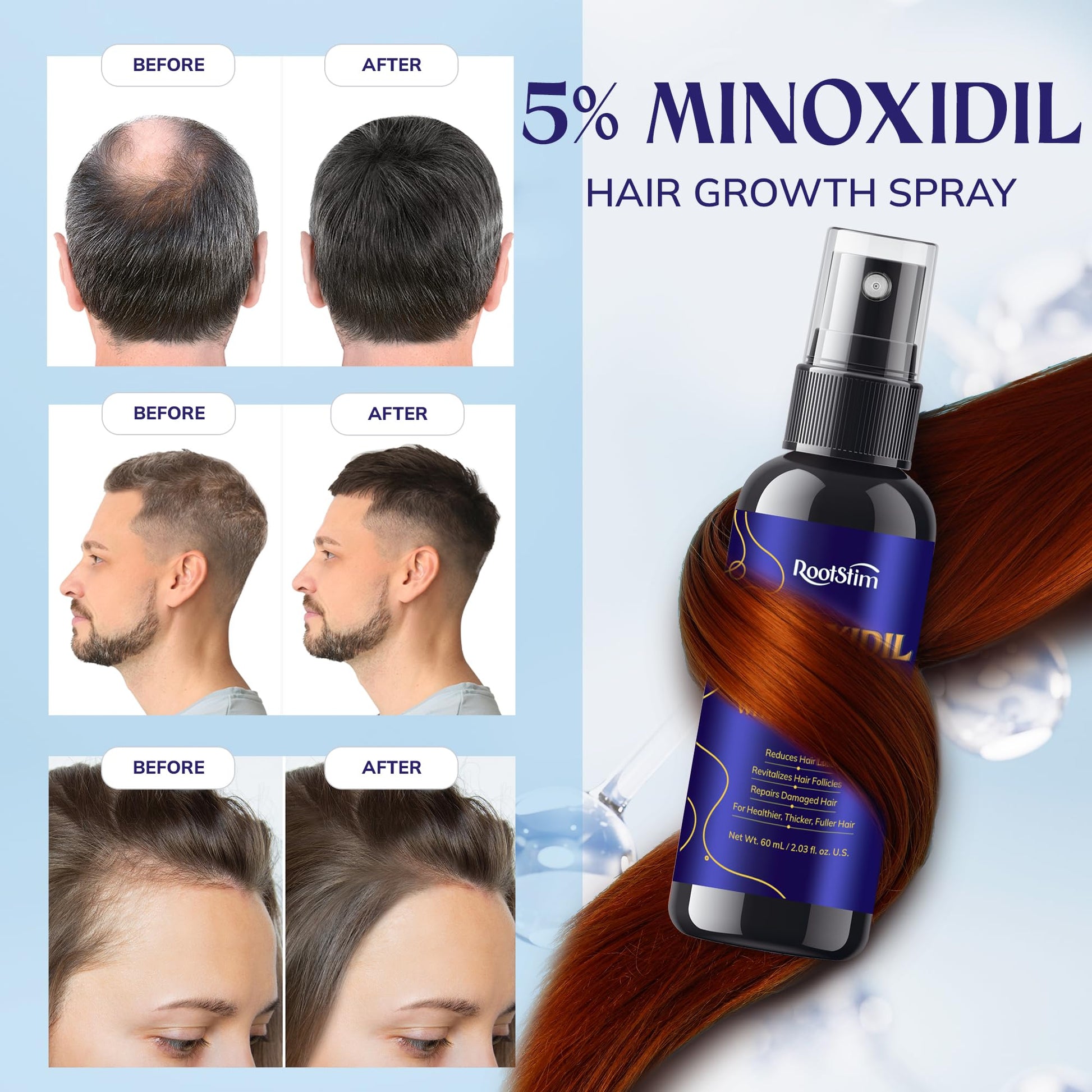 5% Minoxidil Hair Growth for Men and Women: 2-Pack Extra Strength Minoxidil Hair Loss Treatment Serum with Rosemary for Faster Stronger Thicker Hair Growth - 60ML Each - Medaid International