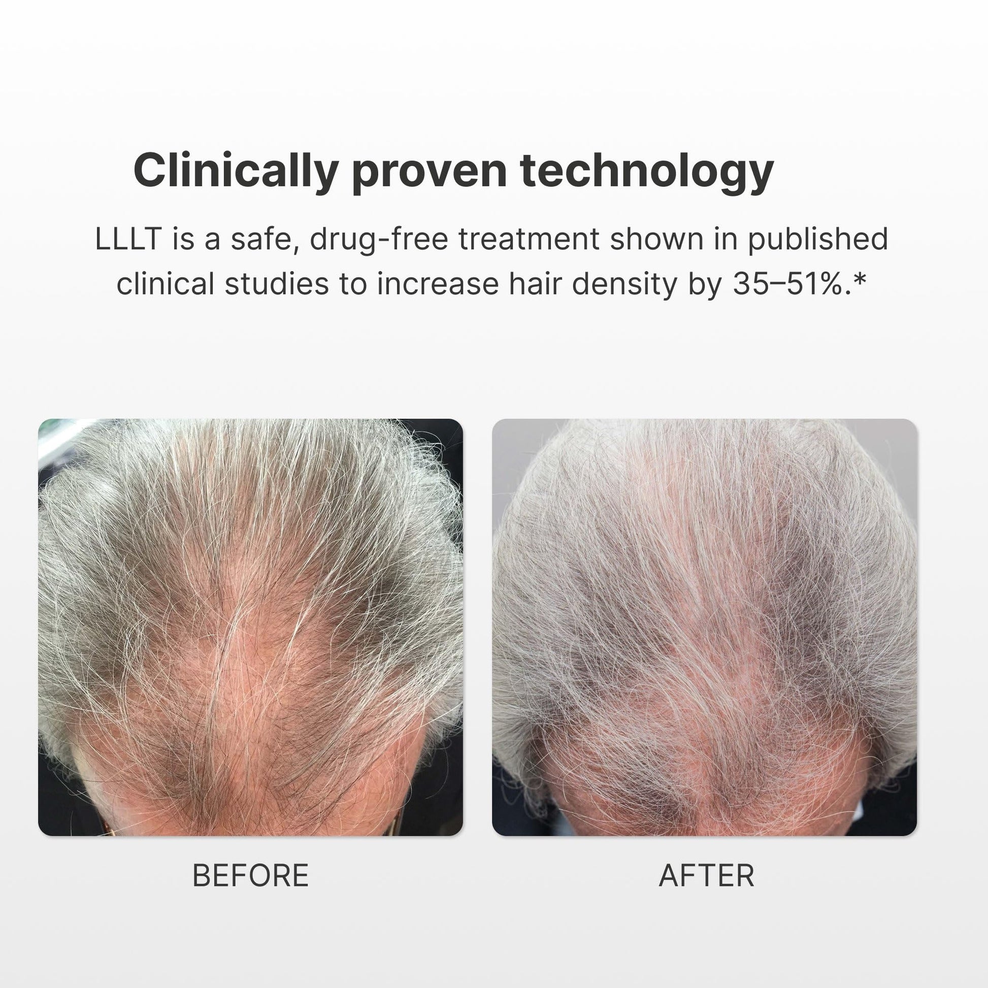 Xtrallux Turbo Pro Laser Hair Growth Cap with 316 Lasers – 6 Minute Treatment Time for Thinning Hair | Hair Loss Treatment | Hair Regrowth Cap for Men and Women - Medaid International