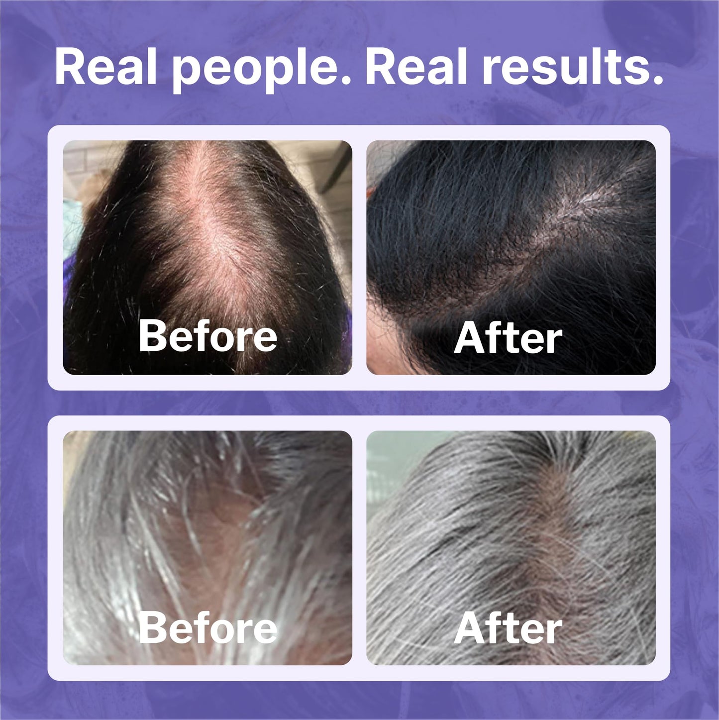 Shapiro MD Hair Growth Experts Minoxidil 2% Topical Solution for Women, Serum Promotes Hair Regrowth by Reactivating Hair Follicles (1 Month) - Medaid International