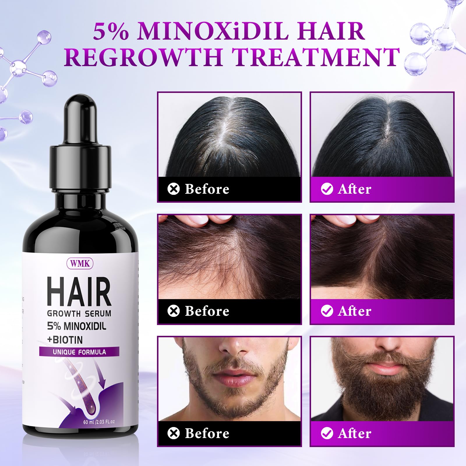 5% Minoxidil for Men and Women Hair Growth Oil, Biotin Hair Serum, 2.03 fl oz - Medaid International
