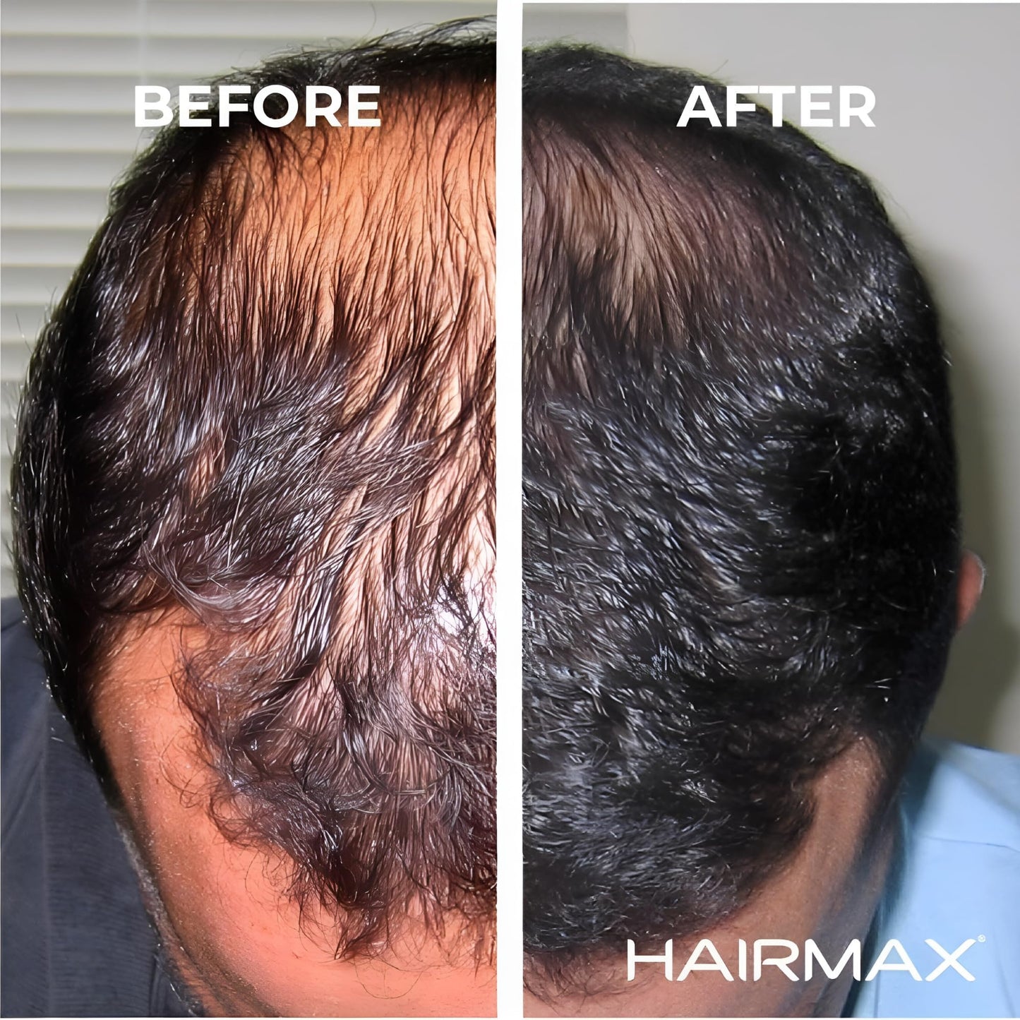 HairMax Ultima 12 LaserComb Hair - Medaid International