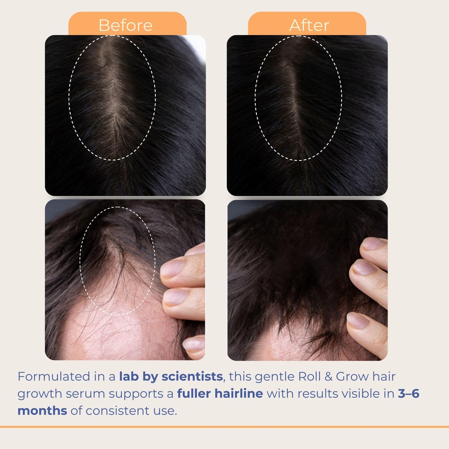 Medulla Clinic Roll & Grow Roll-on Hair Growth Serum with Batana, Rosemary & Biotin - Natural Scalp Treatment for Men & Women - Non-Greasy Easy Application - 1 fl oz | 30 ml - Medaid International