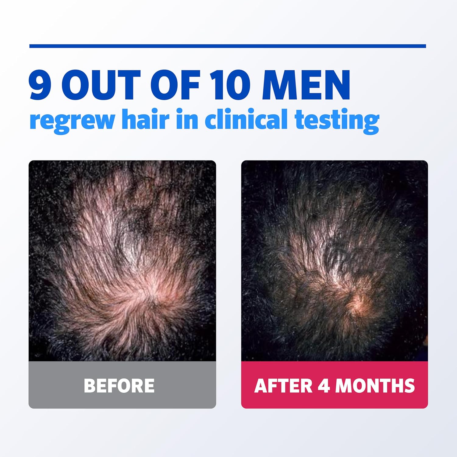 Men’s Rogaine 5% Minoxidil for Men Foam, Clinically Proven Regrowth for Thinning Hair, Topical Hair Loss Treatment, Unscented Topical Aerosol, Results in 8–16 Weeks, 3-Month Supply, 3 x 2.11 oz - Medaid International