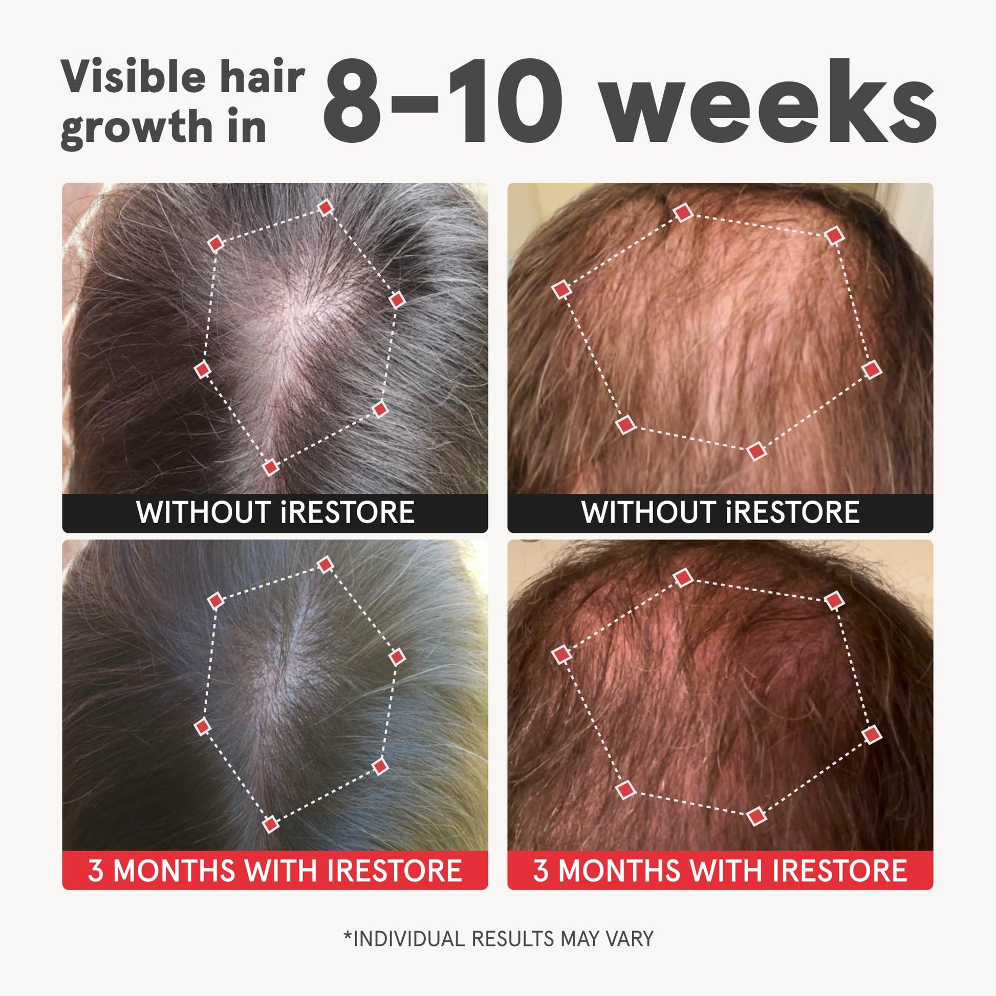 iRestore Advanced Hair Growth Supplement for Women with Lustriva, Hair Vitamins for Faster Hair Regrowth, Best for Hair Loss and Thinning, 1 Month Supply - 1 Count (Pack of 1) - Black - Medaid International