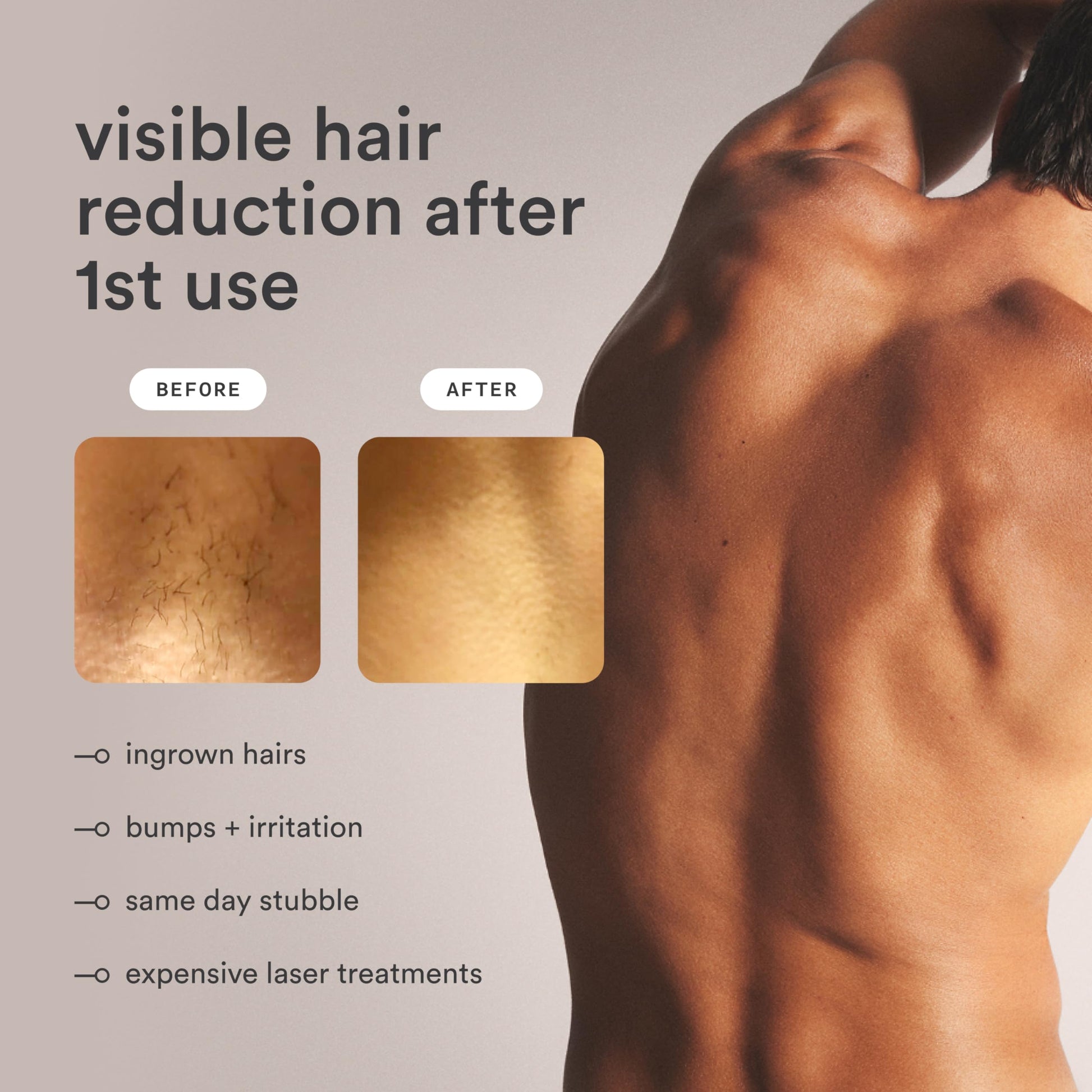 NEW Nood™ Flasher Pro Kit Lite — IPL Laser Hair Removal Device for Women & Men + Refillable 5-Blade Shaving Razor Kit + Exfoliating Buff Bar + After Shave Serum to Slow Hair Regrowth — Gloss White - Medaid International