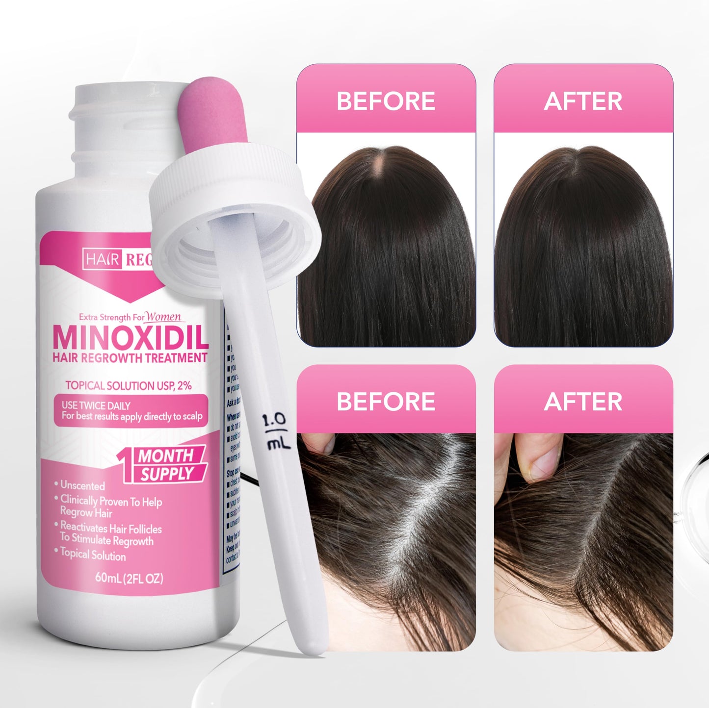 Hair-Regen Advanced 2% Minoxidil For Women, Hair Regrowth Treatment for Thinning Hair, Hair Loss for Women,6 Month Supply, Minoxidil Topical Solution for Thicker Fuller Hair - Medaid International