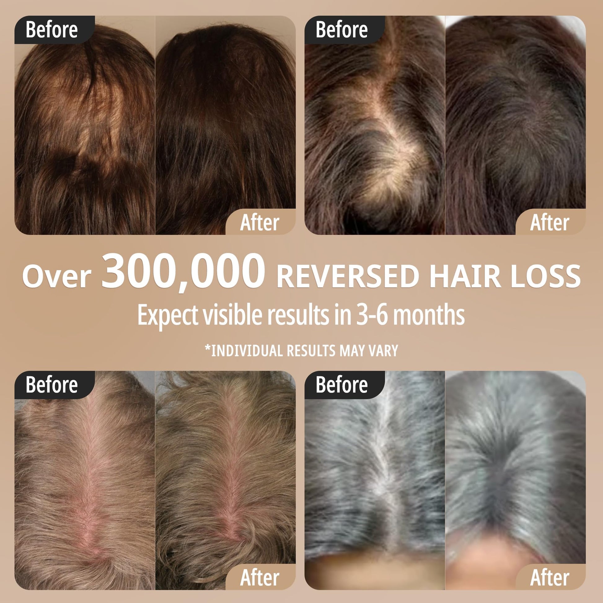 Breo Scalp 3L Laser Hair Growth Comb with 650nm Infrared Technology, 360° Scalp Massager, Waterproof Design, Effective Scalp Stimulation and Hair Regrowth - Medaid International