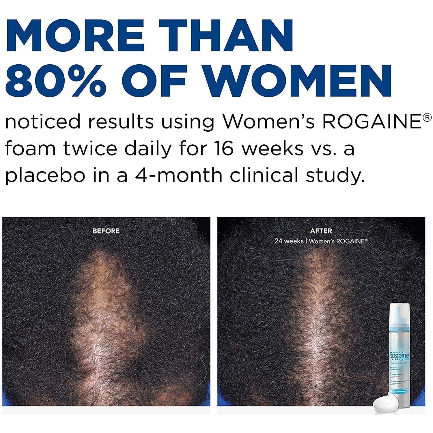 Rogaine 5% Minoxidil Foam, Topical Once-A-Day Hair Loss Treatment for Women to Regrow Fuller, Thicker Hair, Unscented, 2-Month Supply, 2.11 oz - Medaid International
