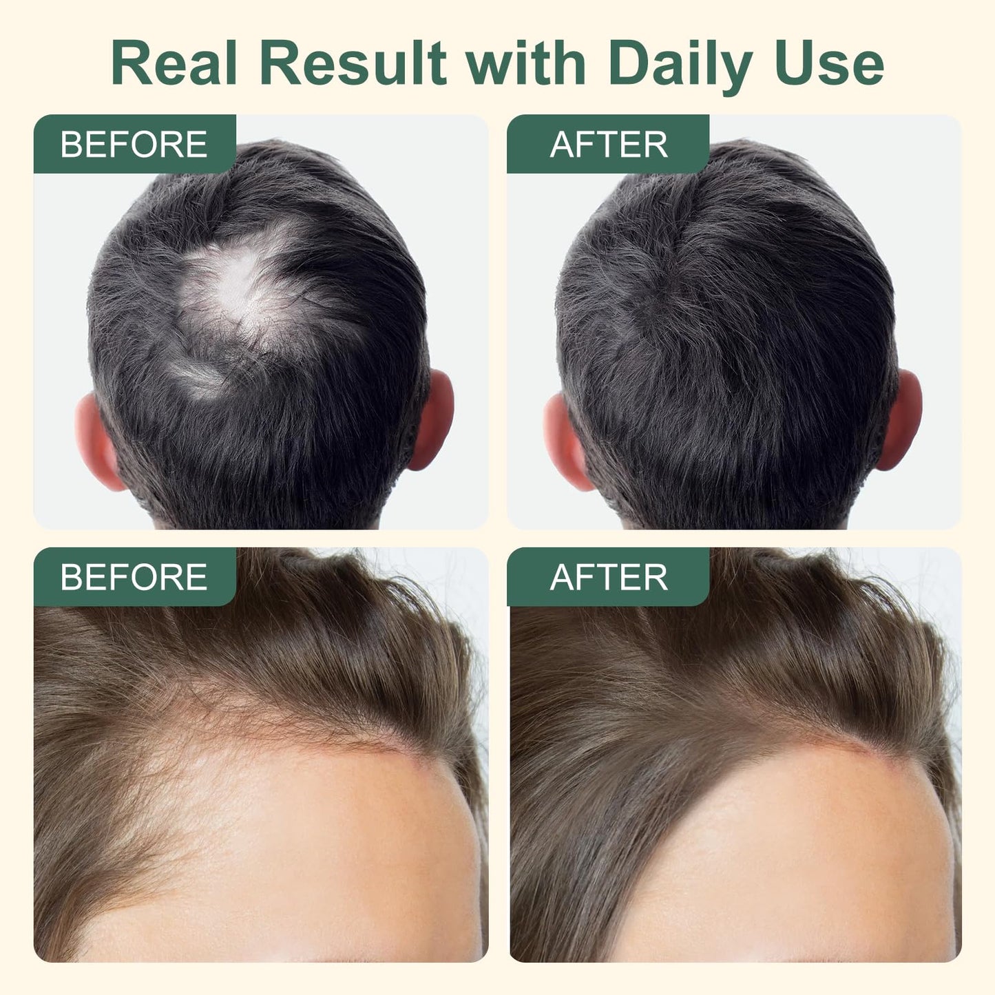 5% Minoxidil Hair Growth for Men and Women, Extra Strength Minoxidil Hair Loss Treatment Serum with Biotin & Herbal Extracts for Faster Thicker Stronger Hair Growth 60mL - Medaid International