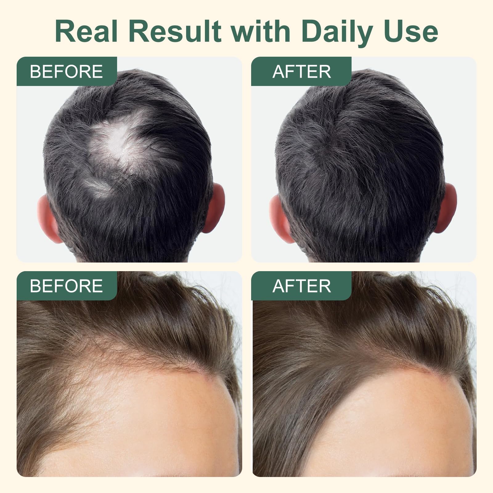 5% Minoxidil Hair Growth for Men and Women, Extra Strength Minoxidil Hair Loss Treatment Serum with Biotin & Herbal Extracts for Faster Thicker Stronger Hair Growth 60mL - Medaid International