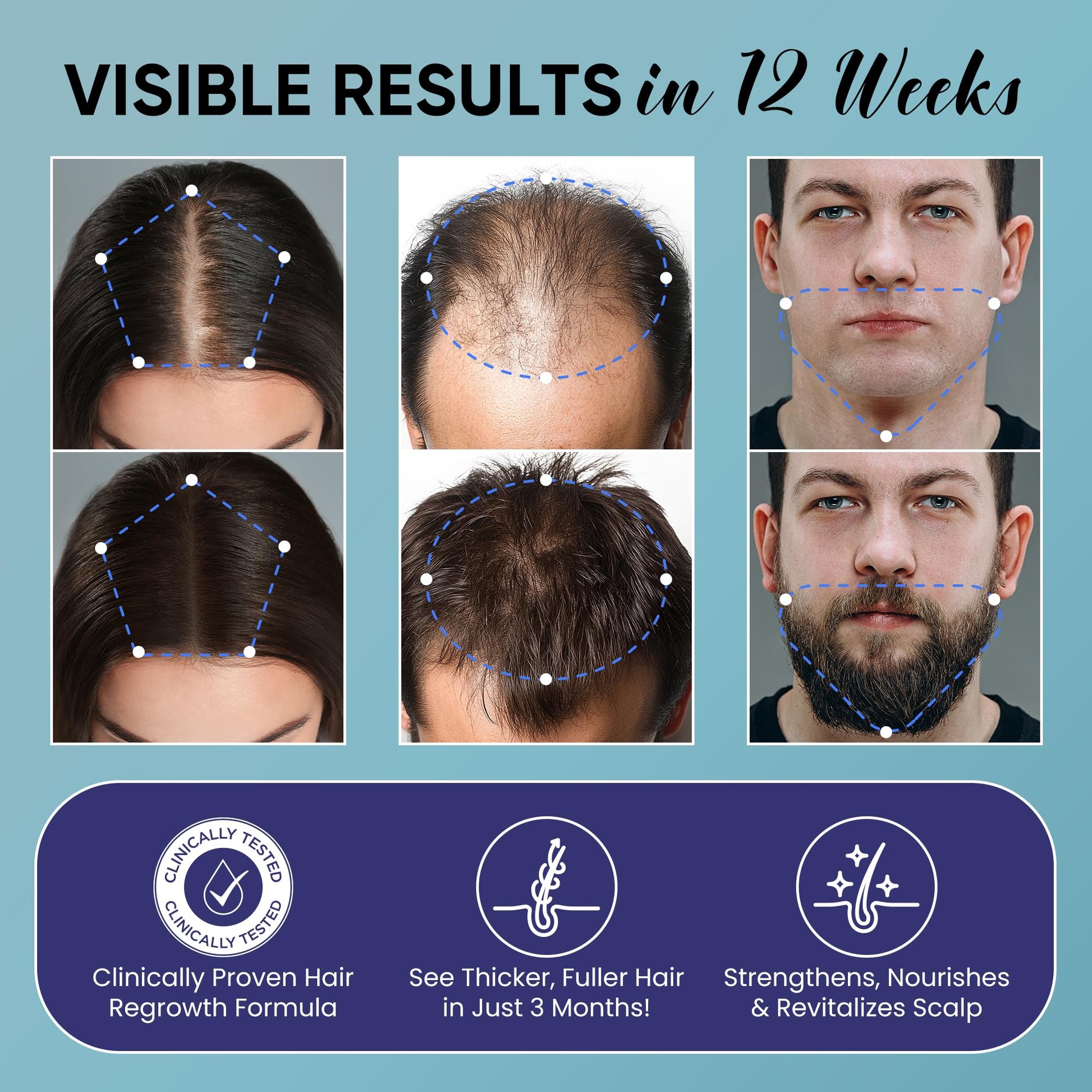 Minoxidil for Men and Women Hair Growth: 5% Minoxidil Spray Hair Regrowth Treatment Serum with Biotin & Rosemary -Stop Hair Thinning and Hair Loss For Stronger Thicker Longer Hair - 2 Pack - Medaid International