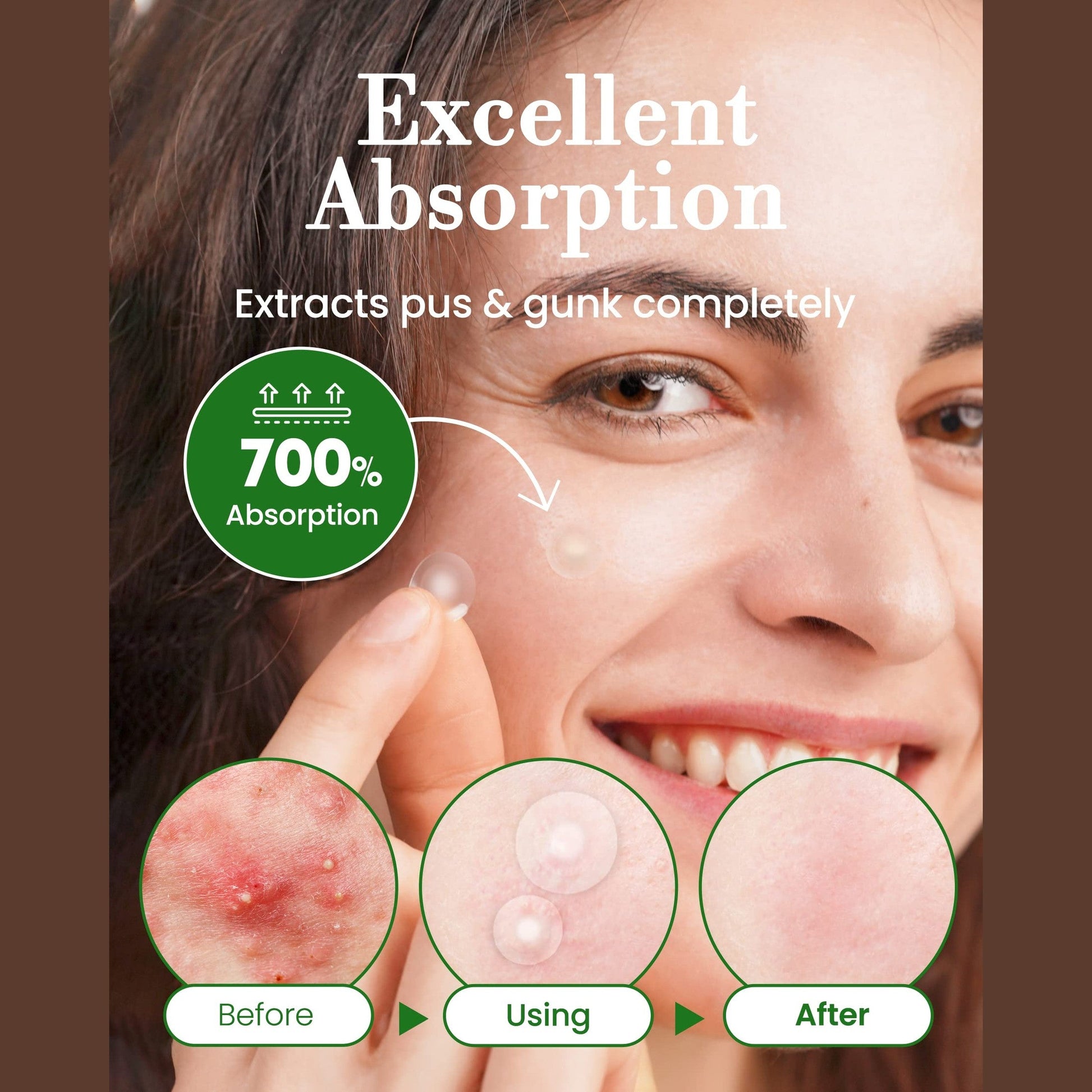 Troubless Invisible Pimple Spot Patch - 96 Ultra Thin Acne Patches - Easy Peel - 2 Sizes - Medaid International