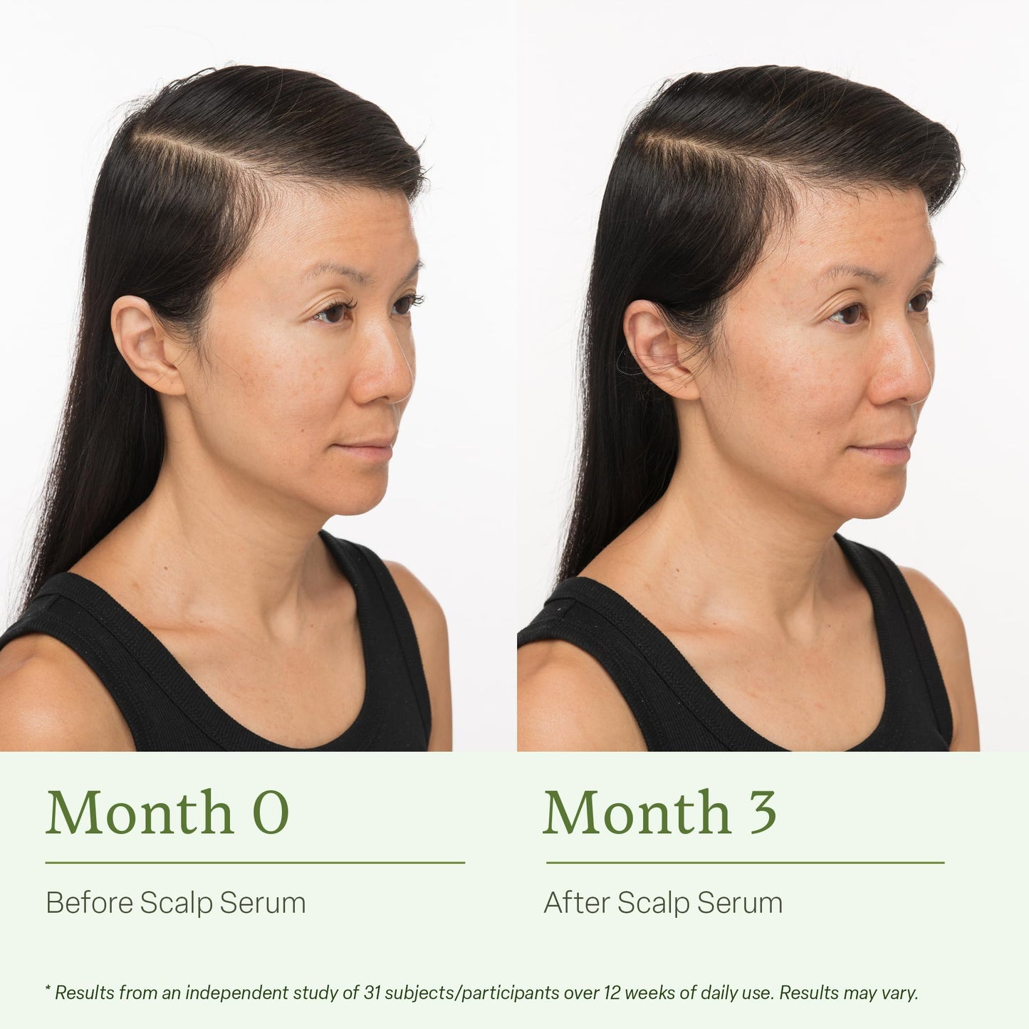 Divi Scalp Serum for Thinning Hair, 30ml – Clinically Tested, Nourishing Formula with Amino Acids, Caffeine & Rosemary Oil – Promotes Healthy Scalp & Fuller-Looking Hair, Reduces Oil & Product Buildup - Medaid International