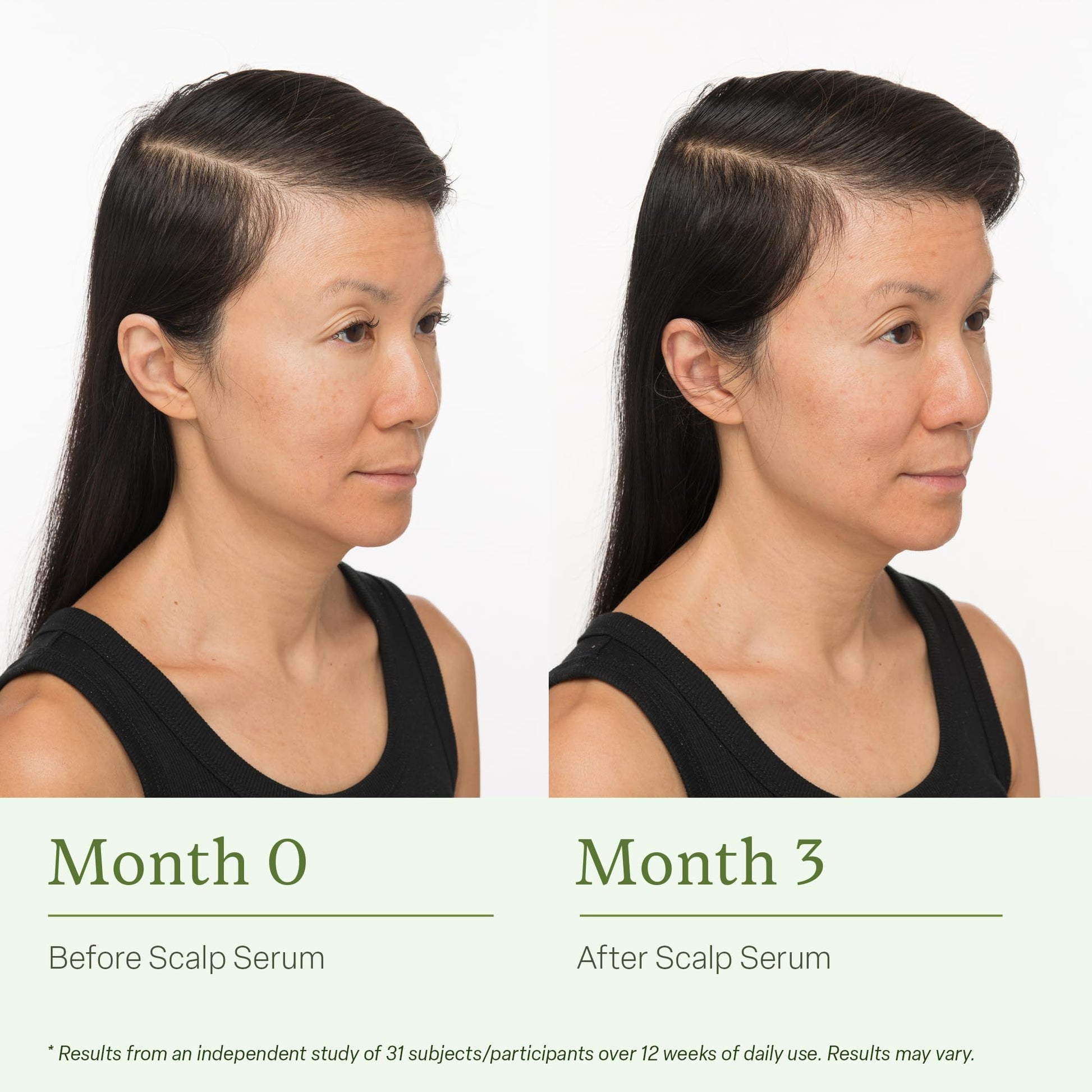 Divi Scalp Serum for Thinning Hair, 30ml – Clinically Tested, Nourishing Formula with Amino Acids, Caffeine & Rosemary Oil – Promotes Healthy Scalp & Fuller-Looking Hair, Reduces Oil & Product Buildup - Medaid International