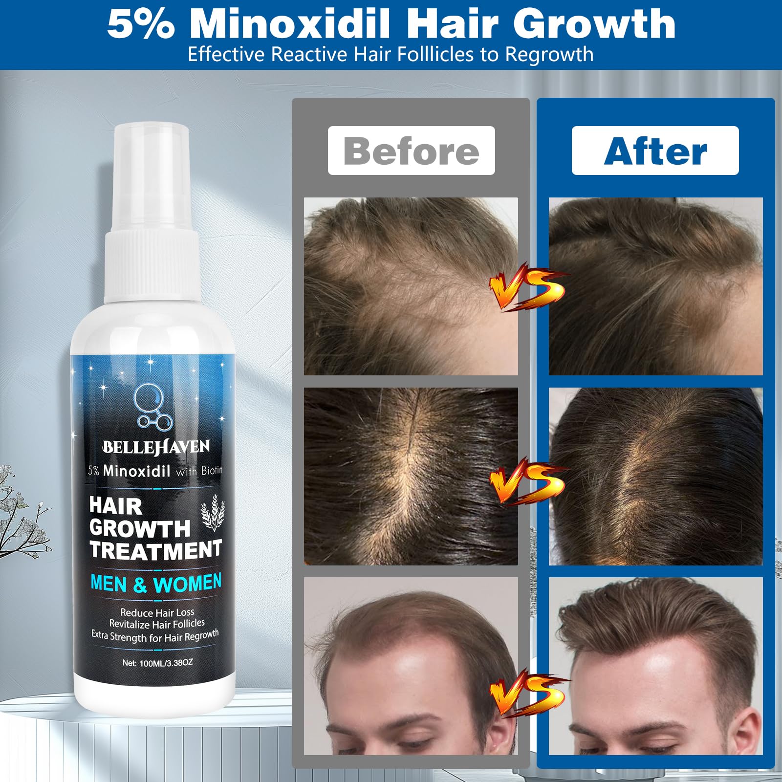 5% Minoxidil Hair Growth Serum for Men and Women - Hair Regrowth Treatment Spray, Topical Solution to Stop Thinning and Hair Loss, 2 Month Supply for Beard and Hair Growth, 100ML - Medaid International