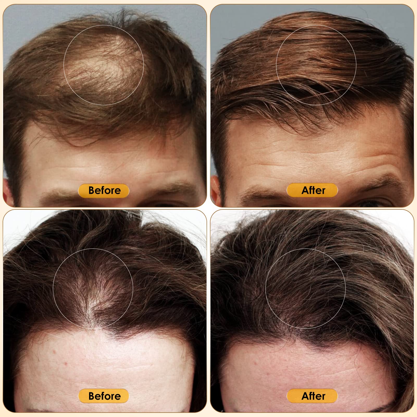 5% Minoxidil for Men & Women Hair Growth - Biotin Minoxidil Serum Oil for Beard Growth Stop Hair Thinning and Hair Loss For Stronger Thicker Longer Hair - Medaid International