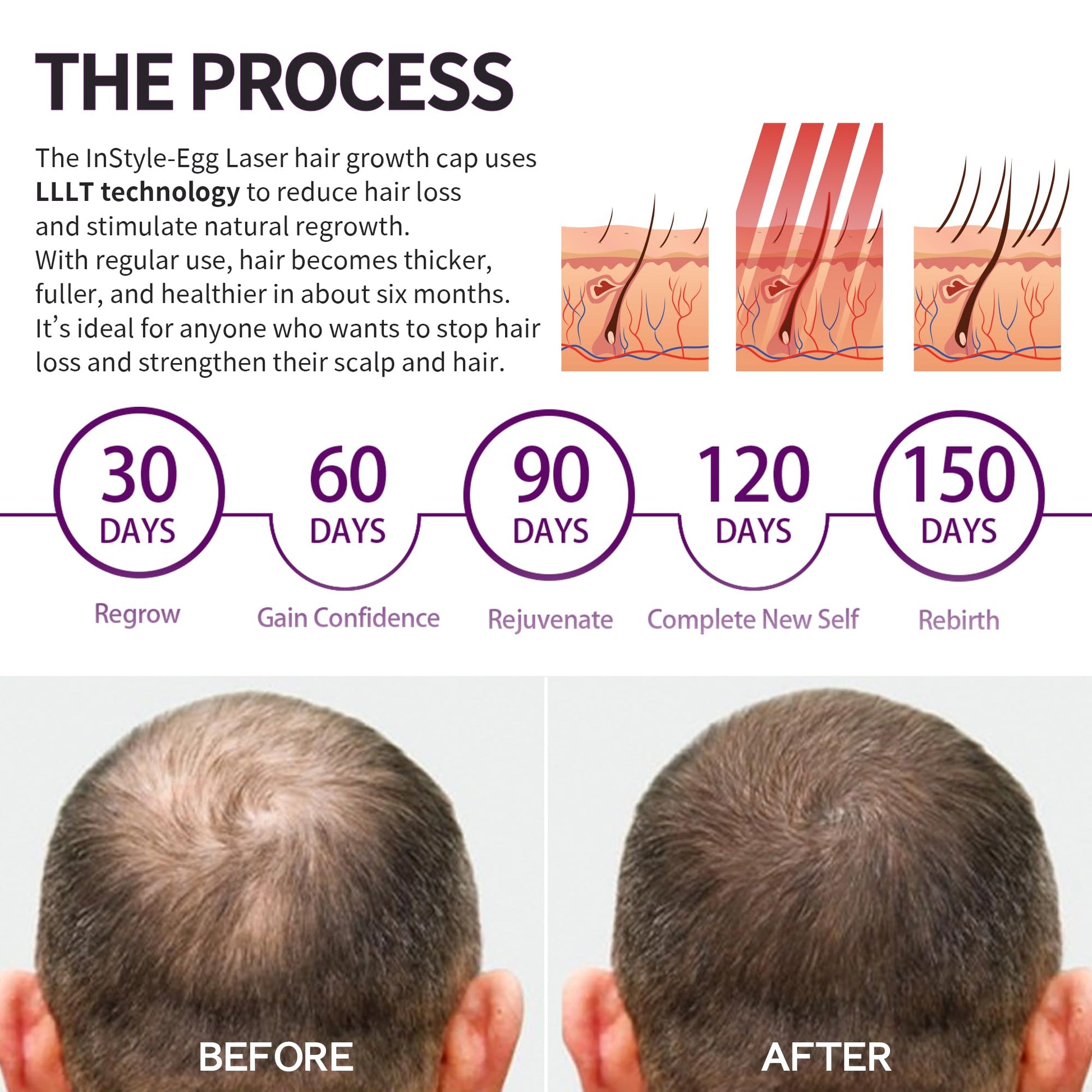 Instyle Egg Laser Hair Growth Cap – 80 Medical-Grade Diodes, FDA Cleared LLLT Red Light Therapy for Hair Regrowth & Thicker Hair, Hair Loss Treatment for Men & Women - Medaid International