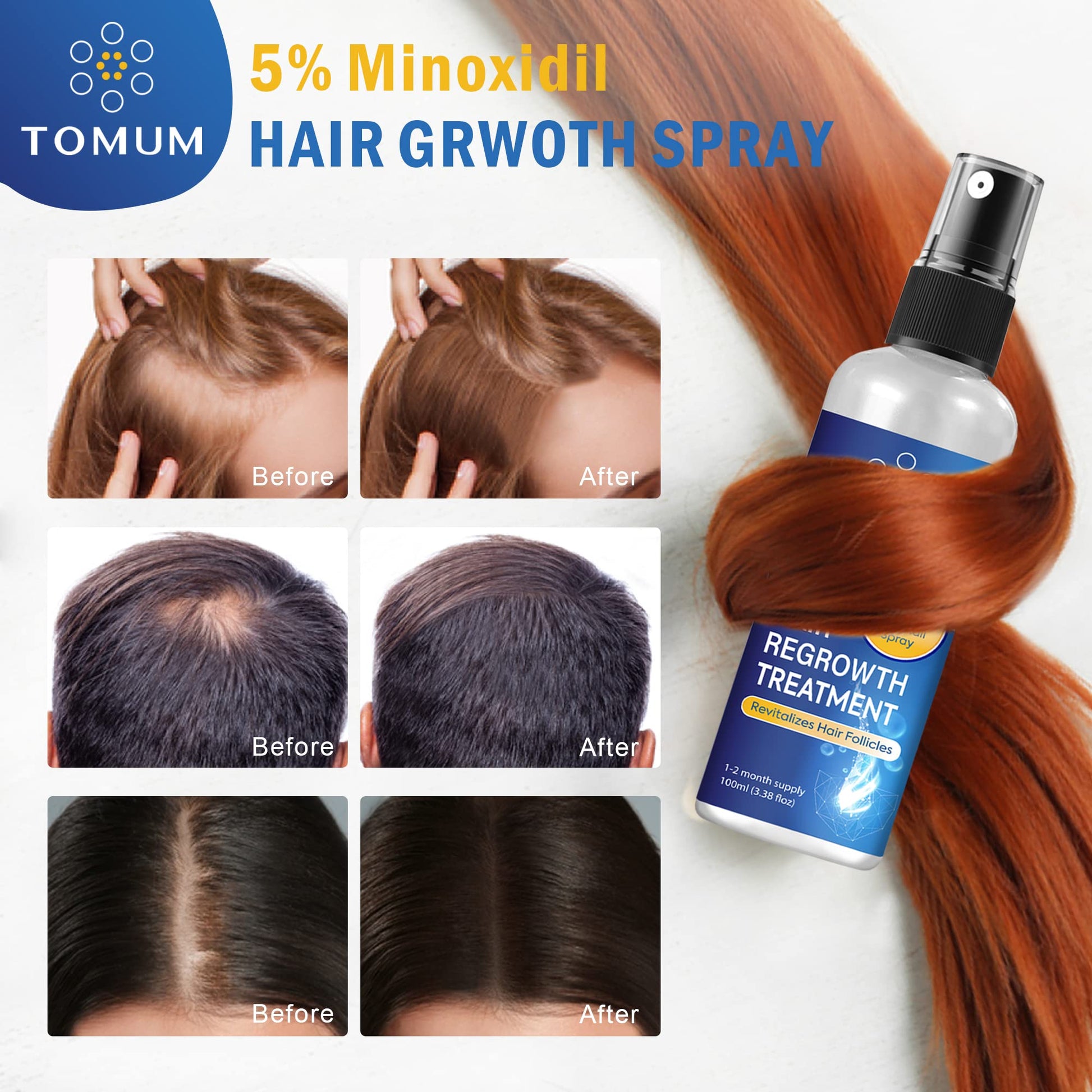 Minoxidil for Men and Women Hair Growth: 5% Minoxidil Spray Hair Regrowth Treatment Serum Stop Hair Thinning and Hair Loss For Stronger Thicker Longer Hair 100ml - Medaid International