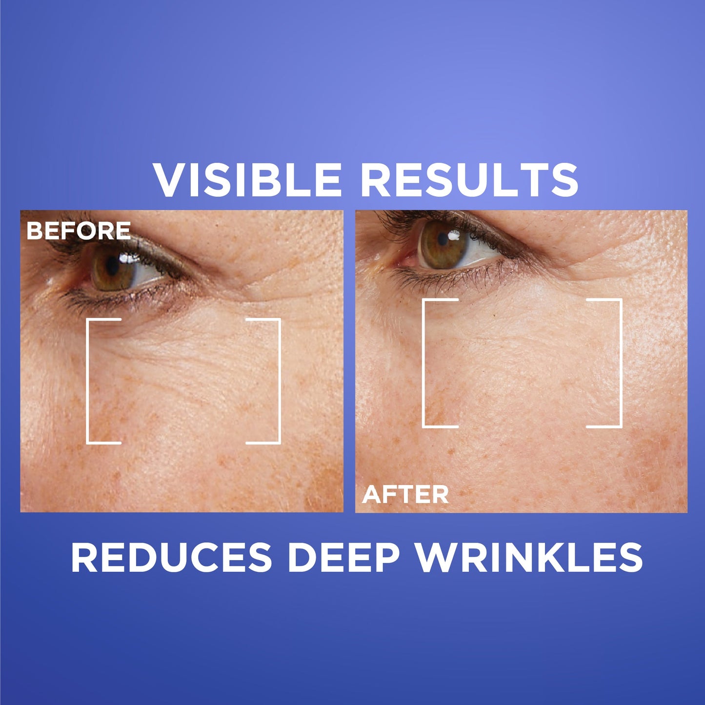 L'Oreal Paris Revitalift Retinol Night Serum With 0.2% Pure Retinol For All Skin Types 30 ml