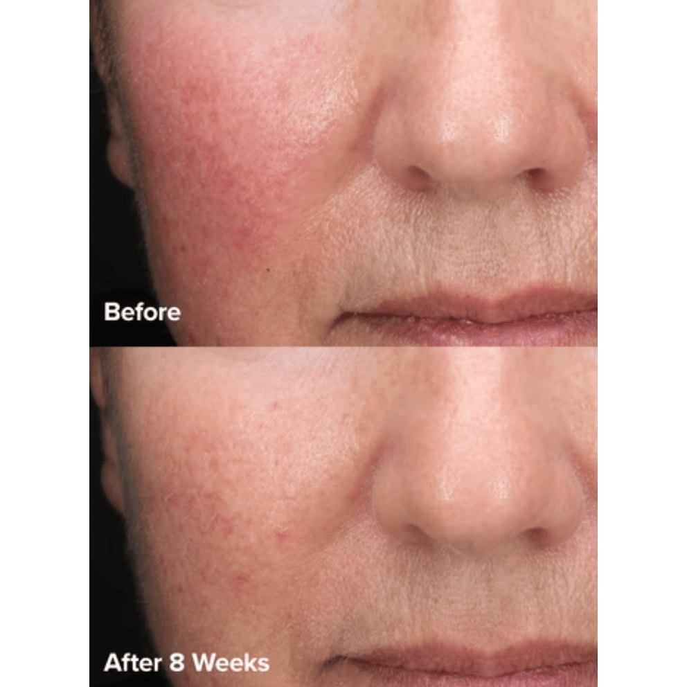 Paula's Choice - Skin Perfecting 6% Mandelic Acid + 2% Lactic Acid Liquid Exfoliant - Medaid International