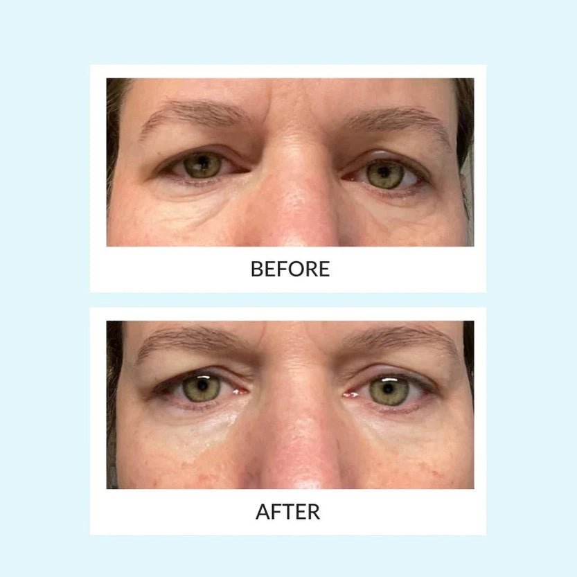 Reusable Eye Therapy Patch ( SOLO PATCH )
