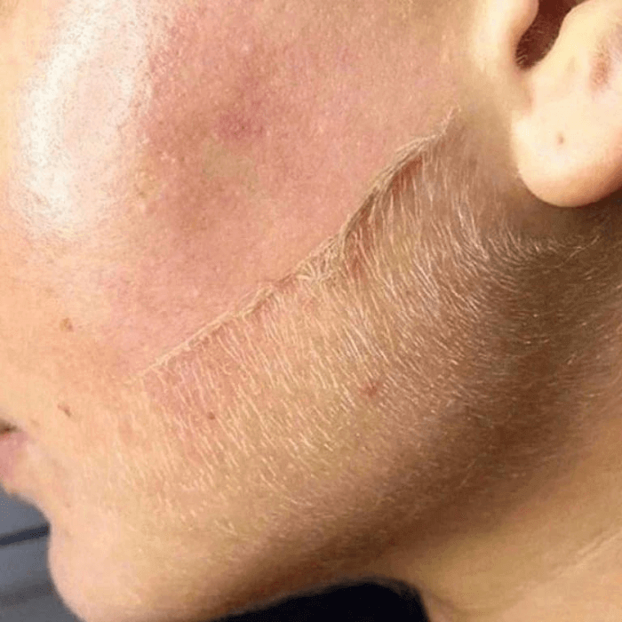 Flawless® Dermaplaning Facial Hair Remover | Exfoliating - Medaid International