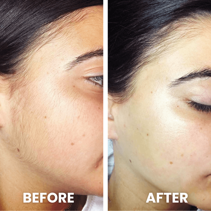 Flawless® Dermaplaning Facial Hair Remover | Exfoliating - Medaid International